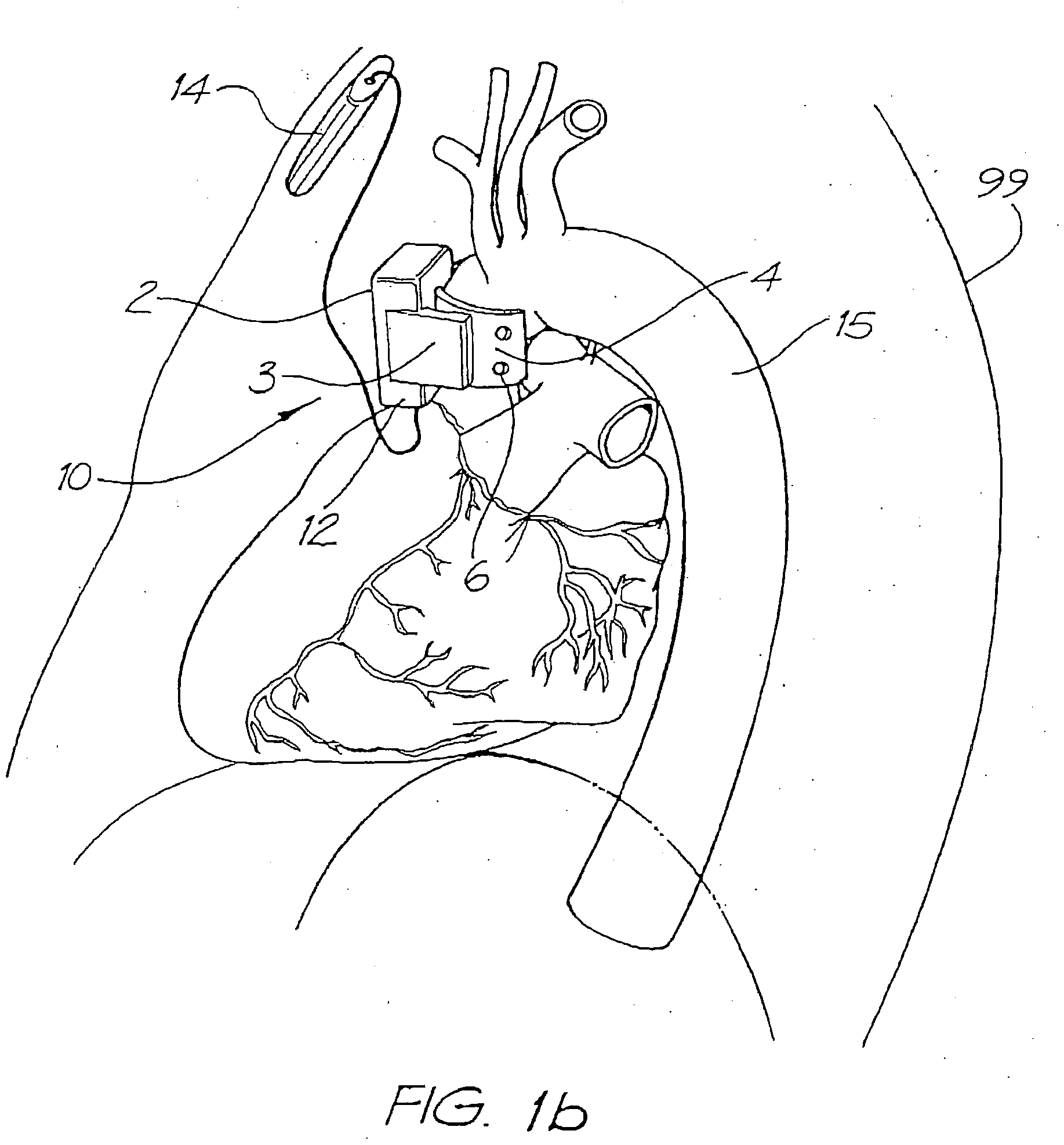 Heart Assist Devices, Systems and Methods