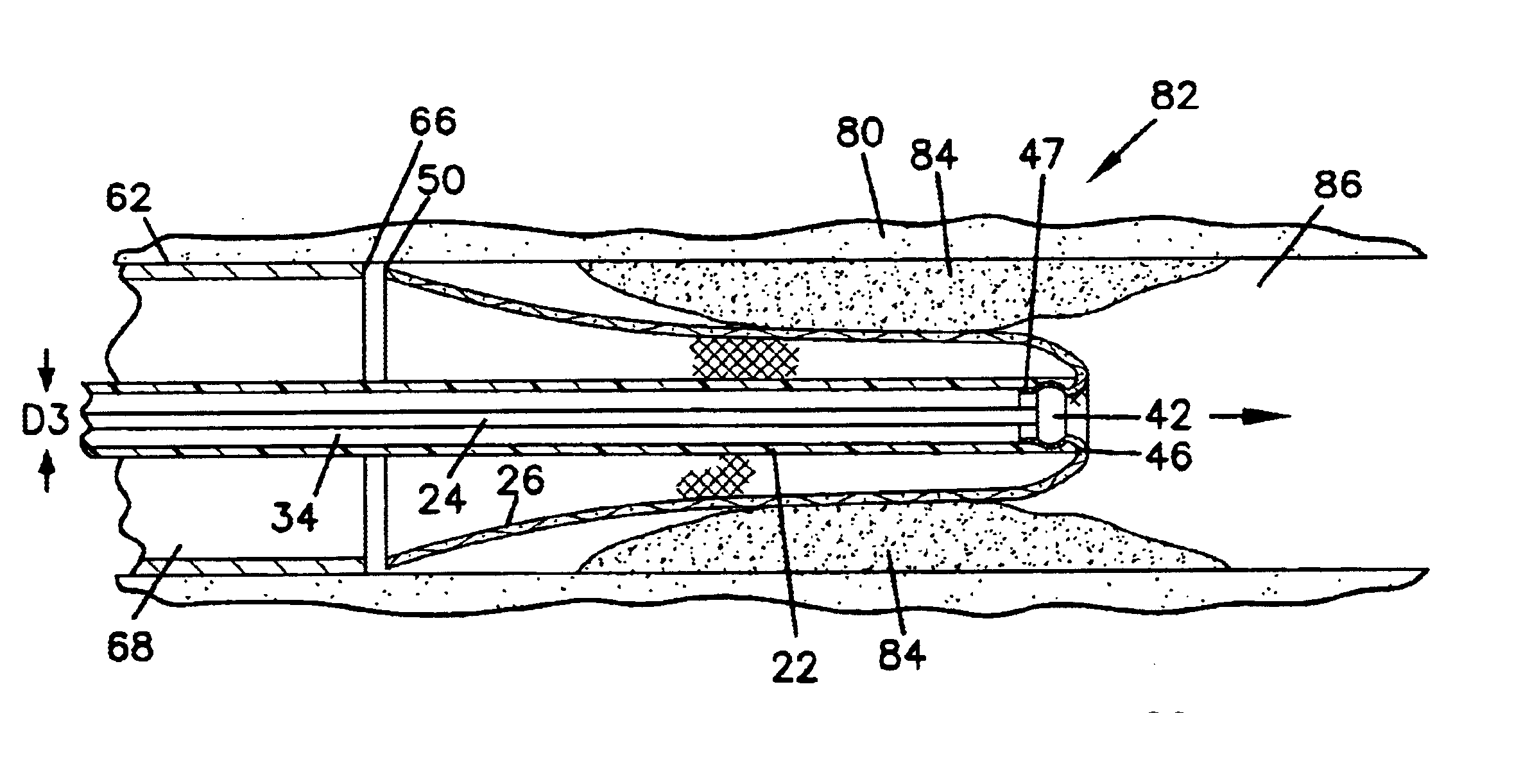 Everting stent and stent delivery system