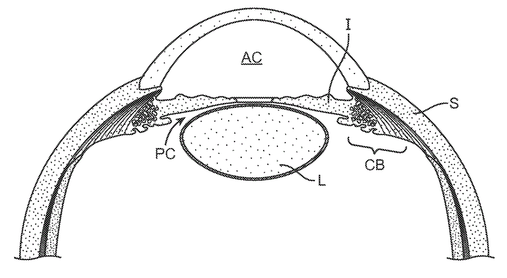 Delivery system for ocular implant
