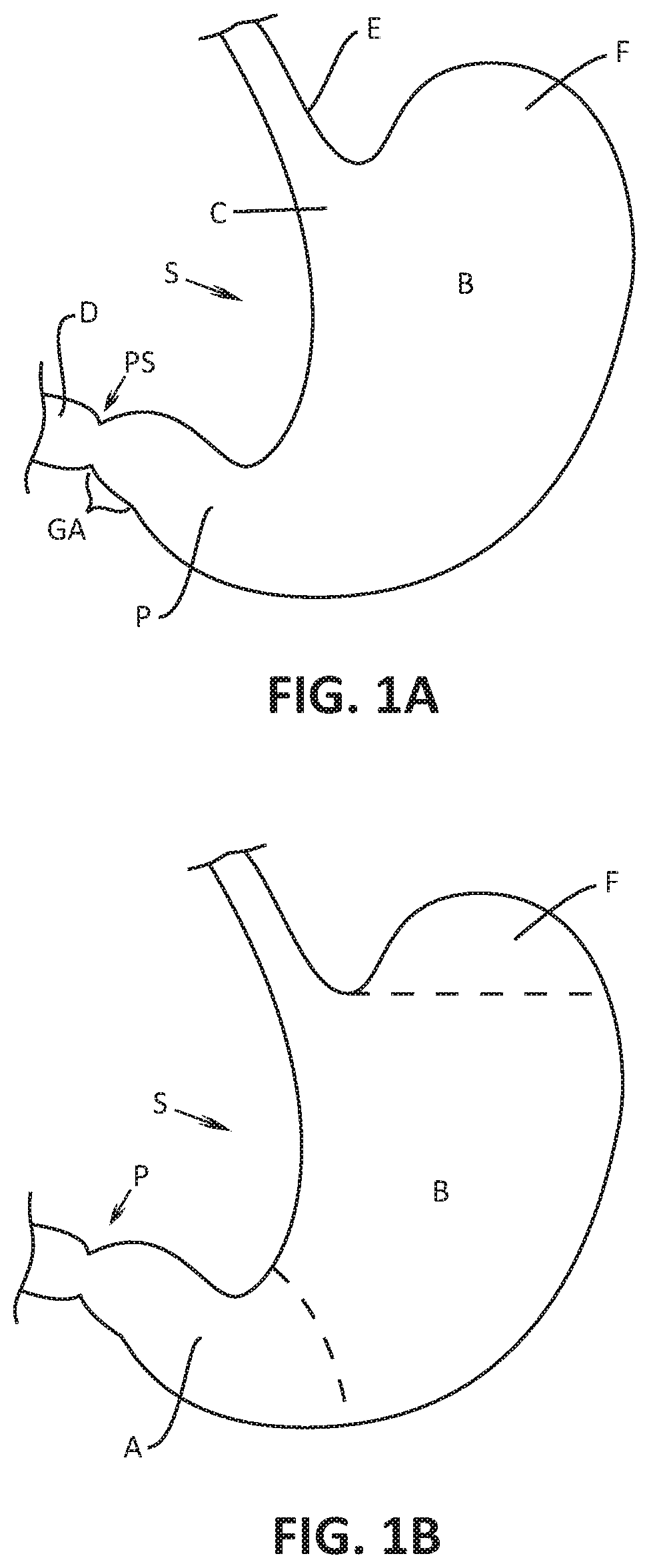 Propulsive drug delivery from a swallowable device into a patients intestinal tract