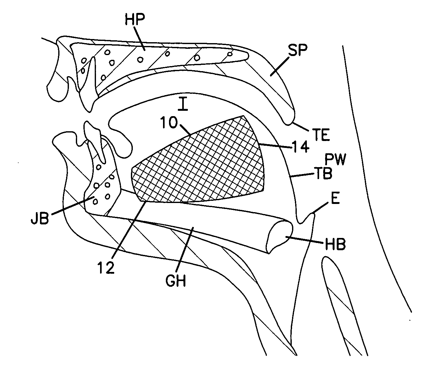 Tongue implant