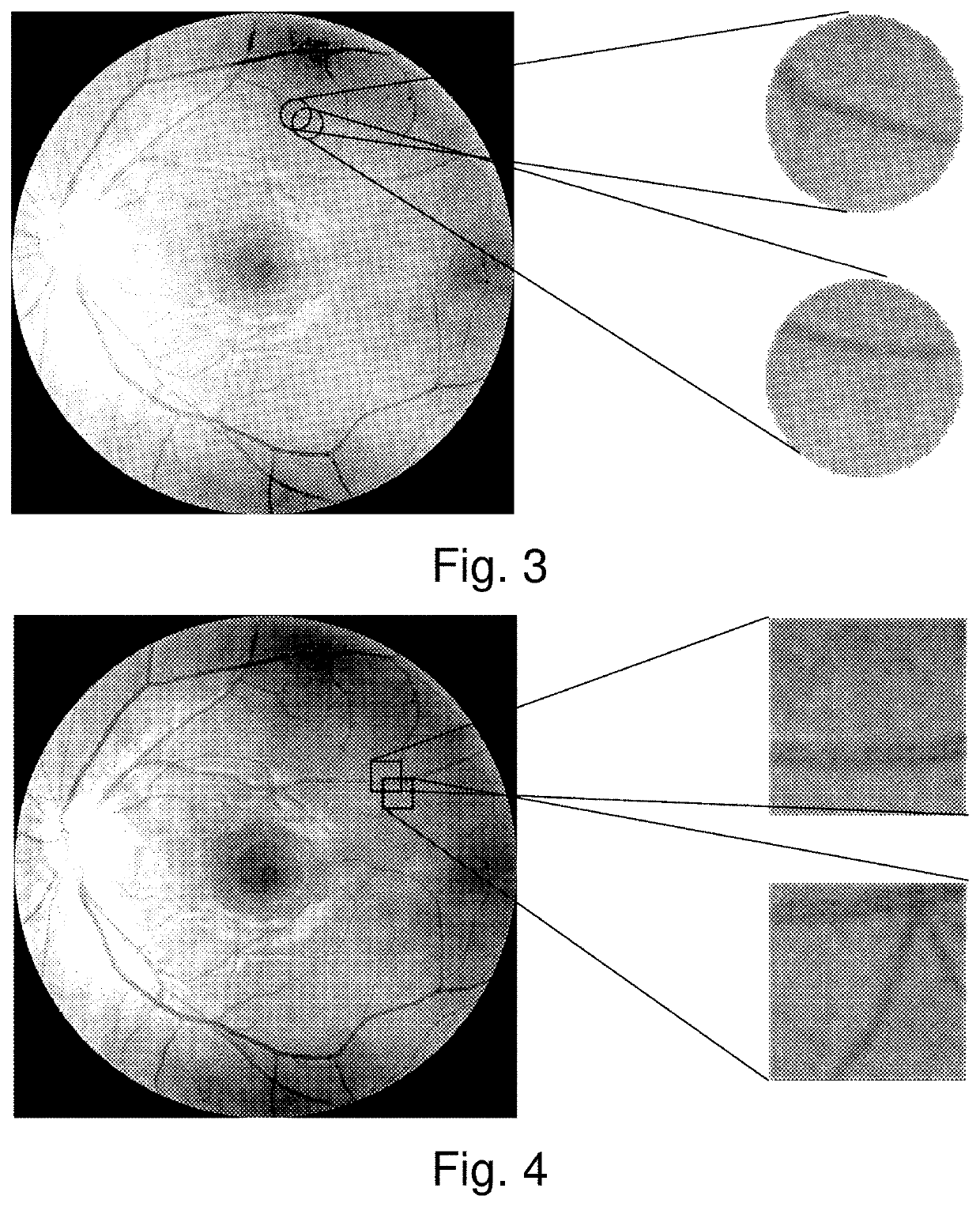 System and method for automated funduscopic image analysis