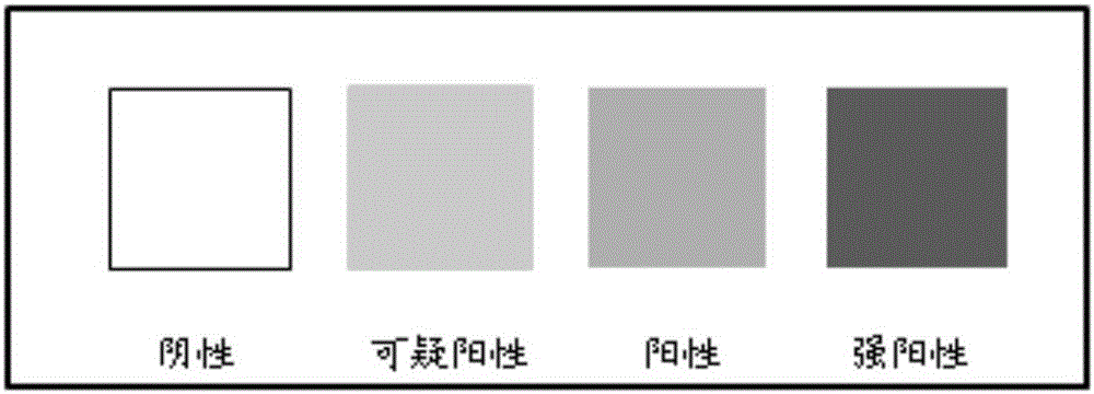 Union application of ferroprotoporphyrin and beta-glucuronidase in prostatic cell heterogeneity hyperplasia detection and kit