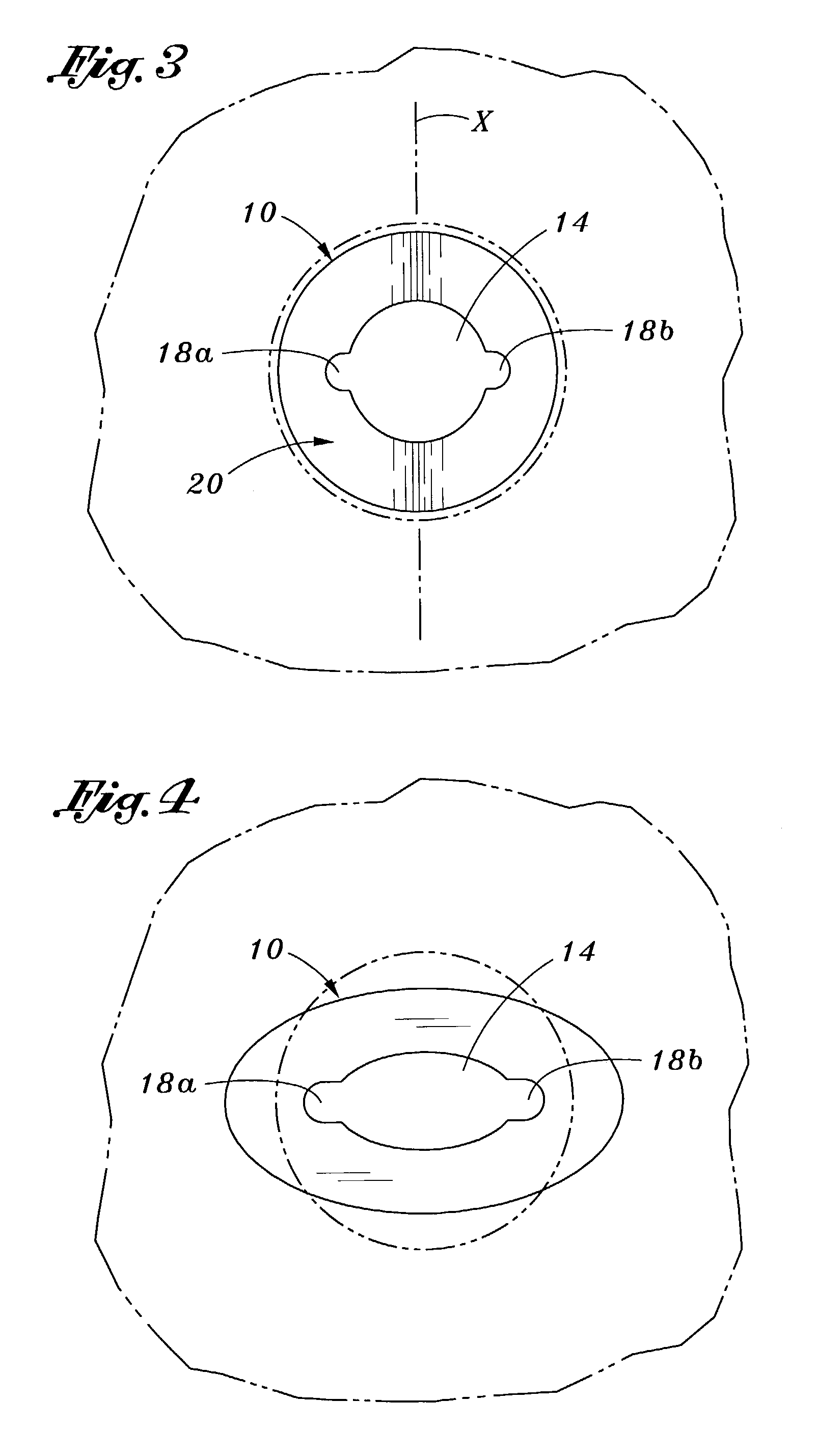 Method and apparatus for attaching connective tissues to bone using a cortical bone anchoring device