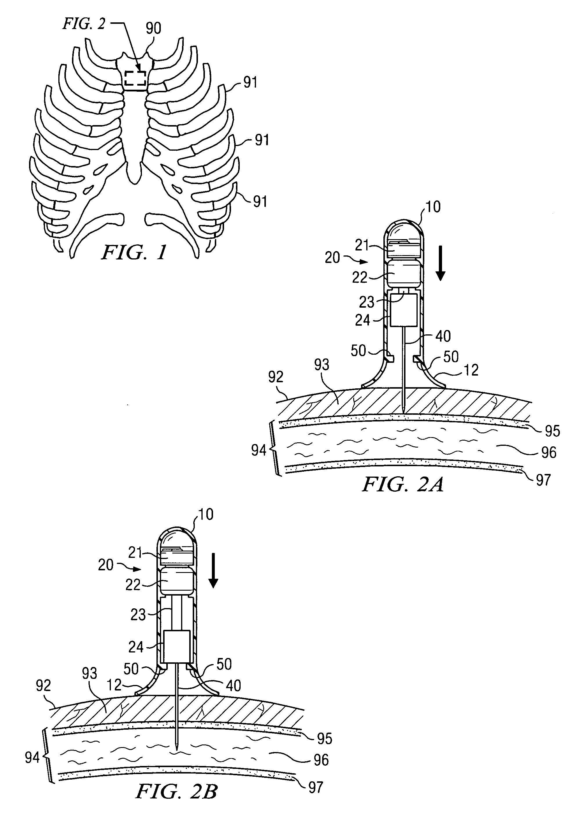 Apparatus and method for accessing the bone marrow of the sternum