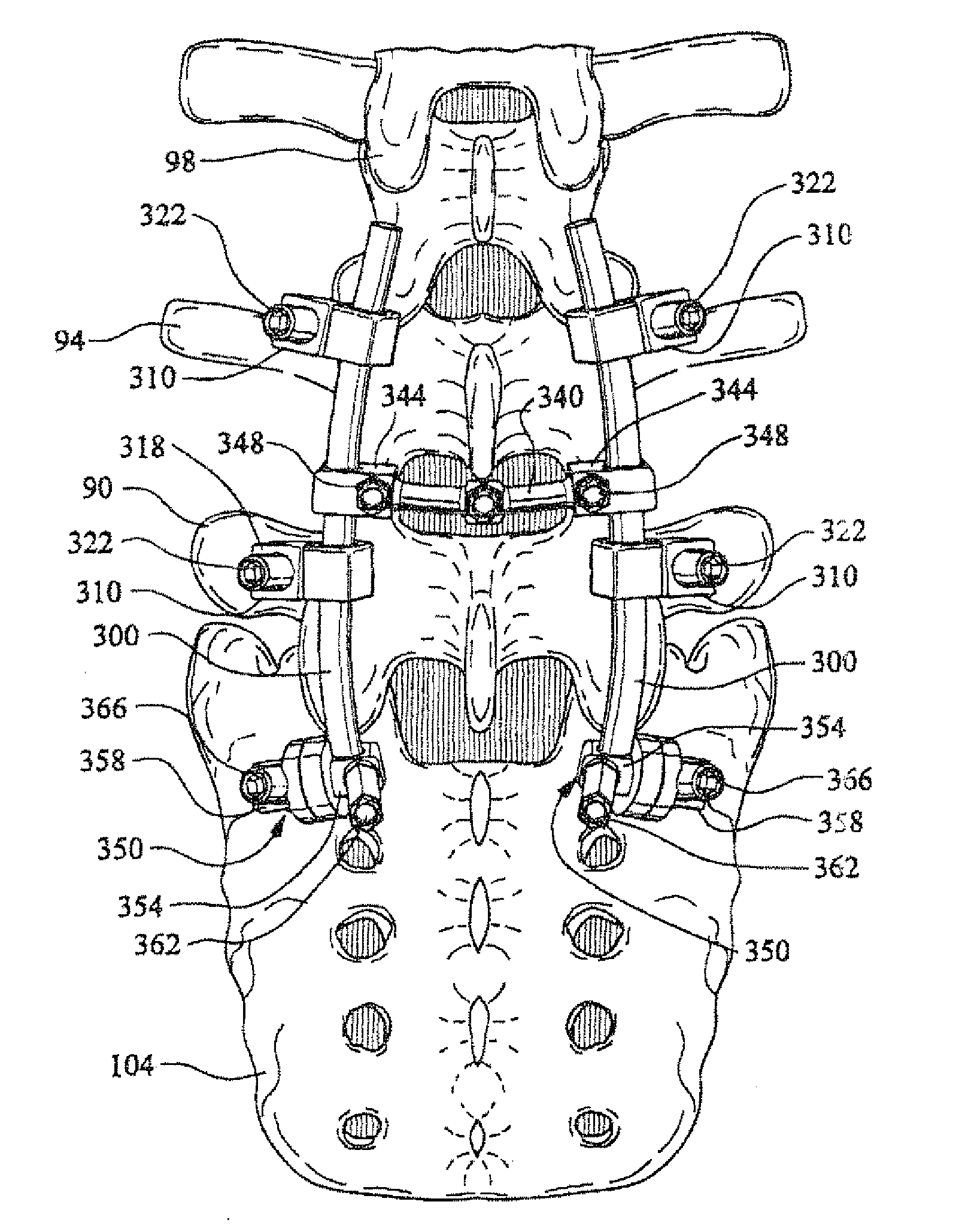 Artificial facet joint and method