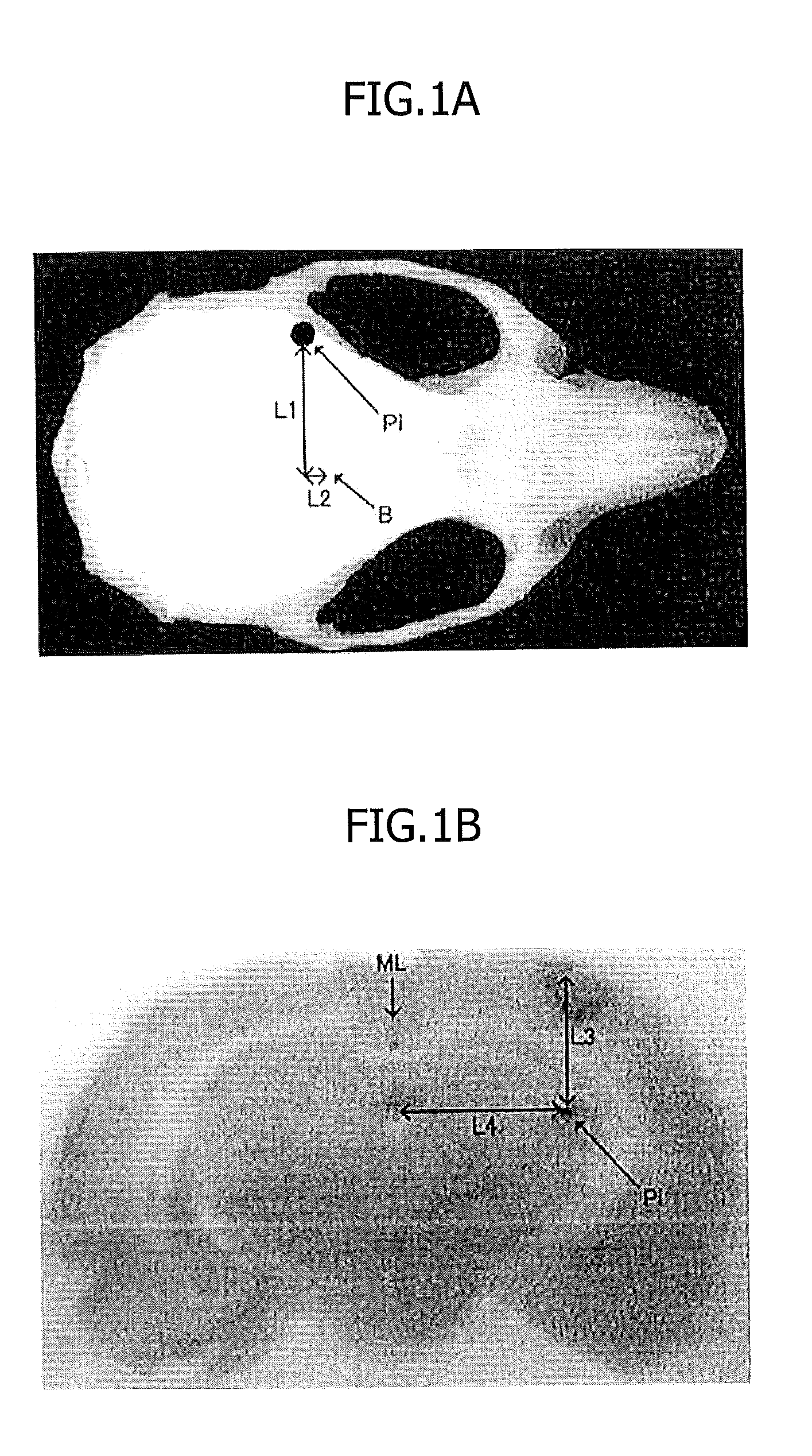 Material for treatment of cerebral infarction and brain tissue regeneration method