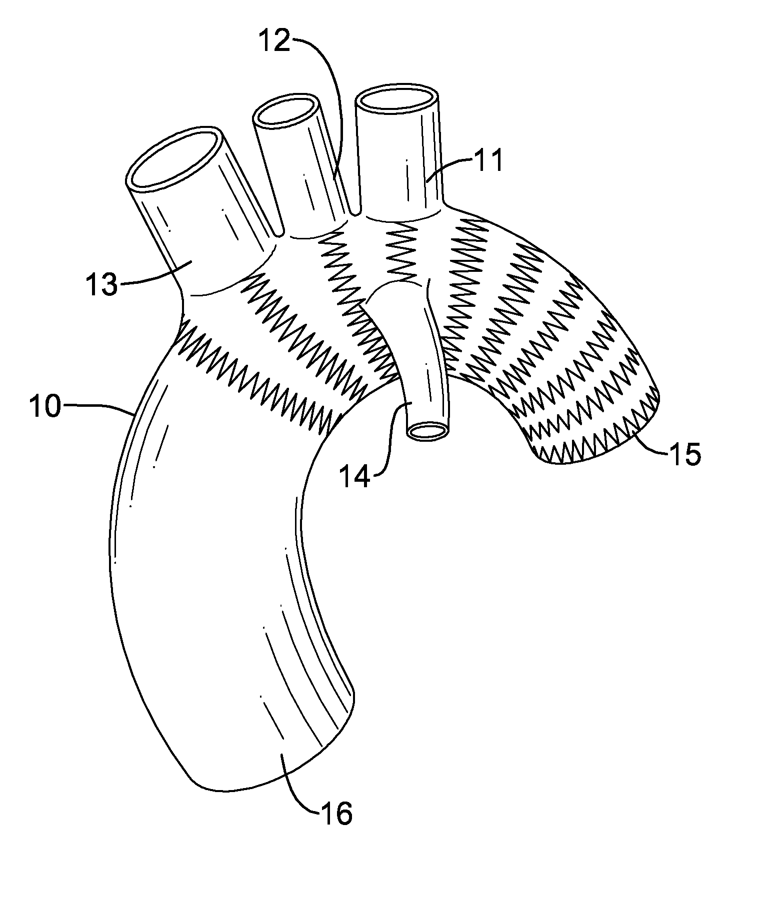 Stent Graft System