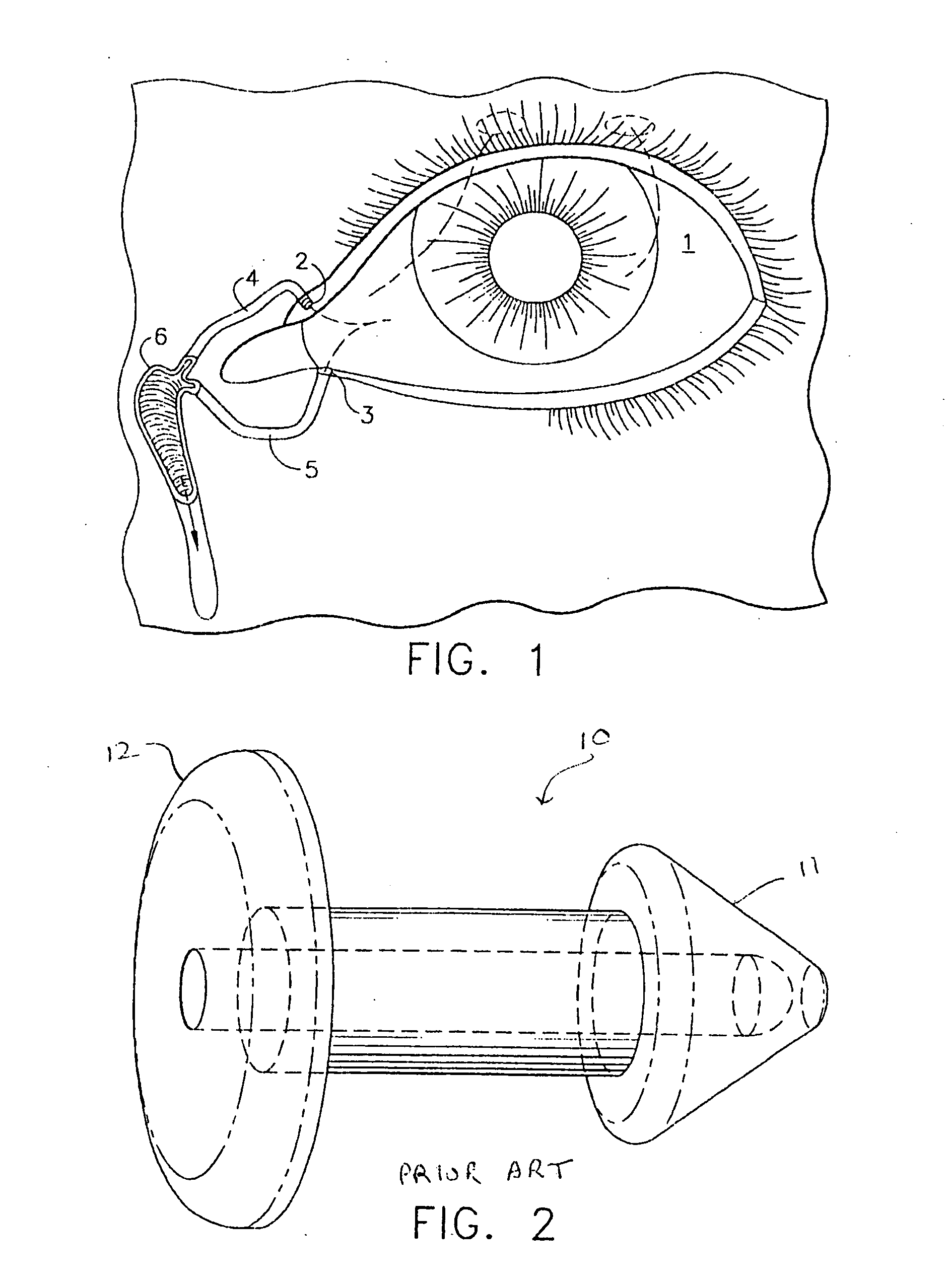Ocular occluder and method of insertion