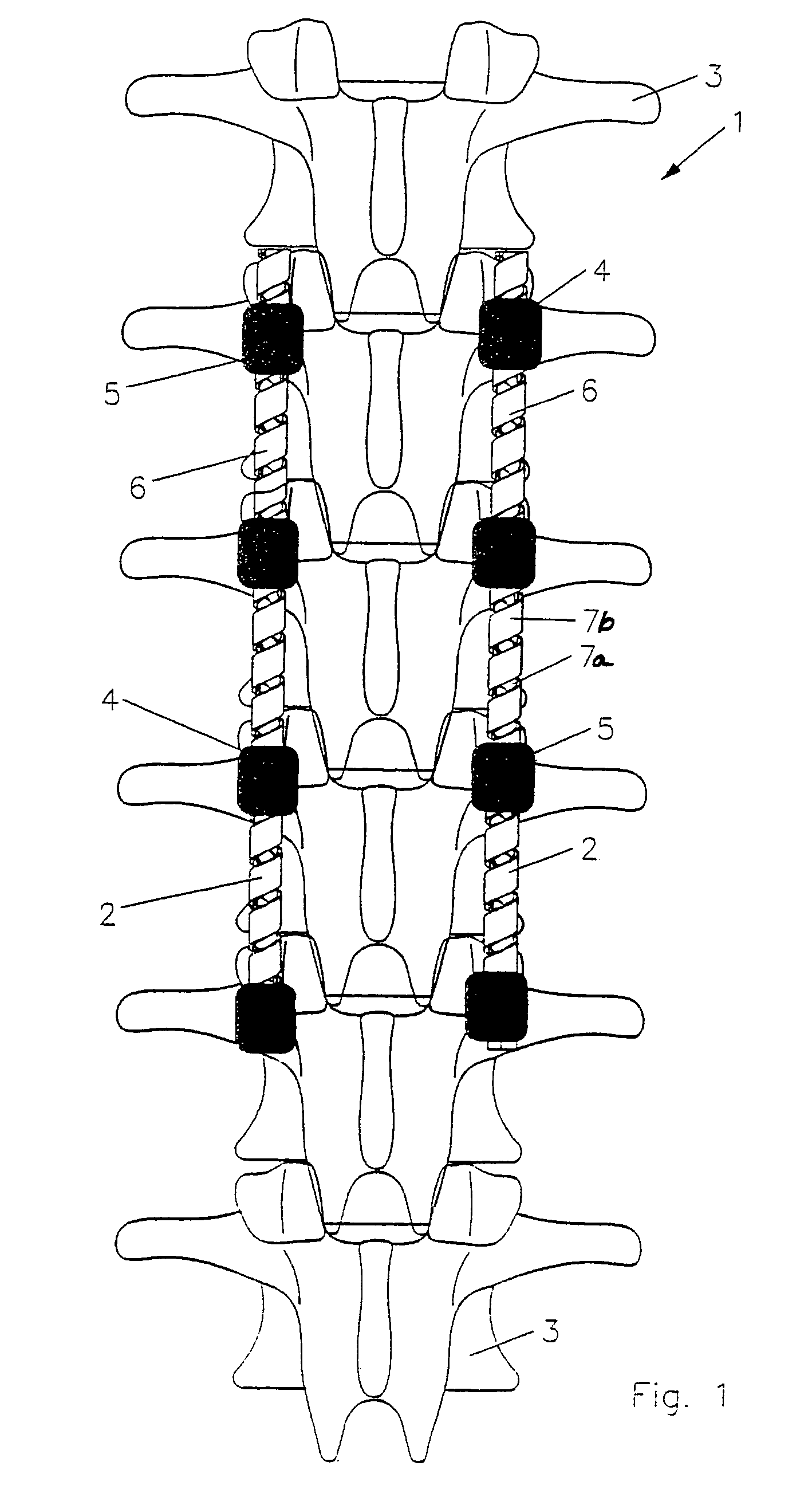 Implant for correction and stabilization of the spinal column