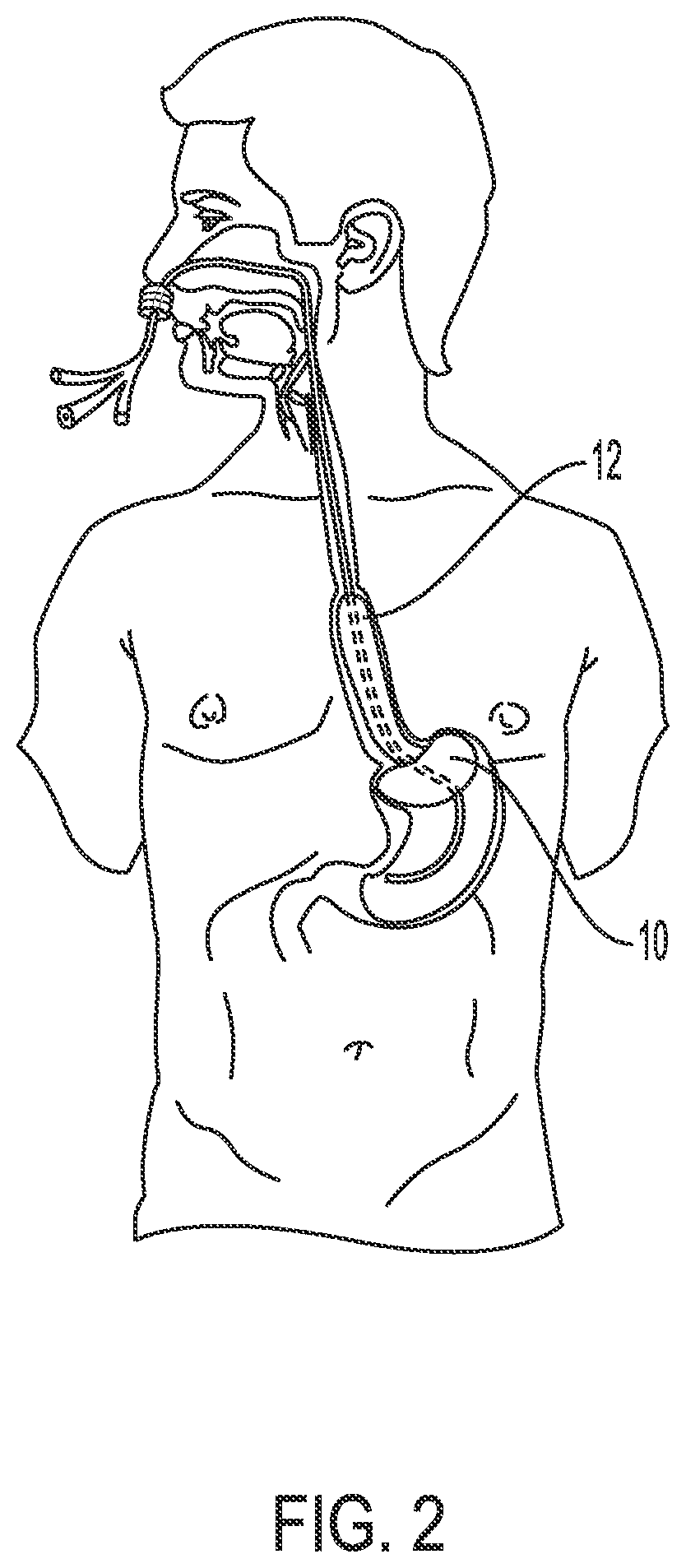Trans-esophageal aortic flow rate control