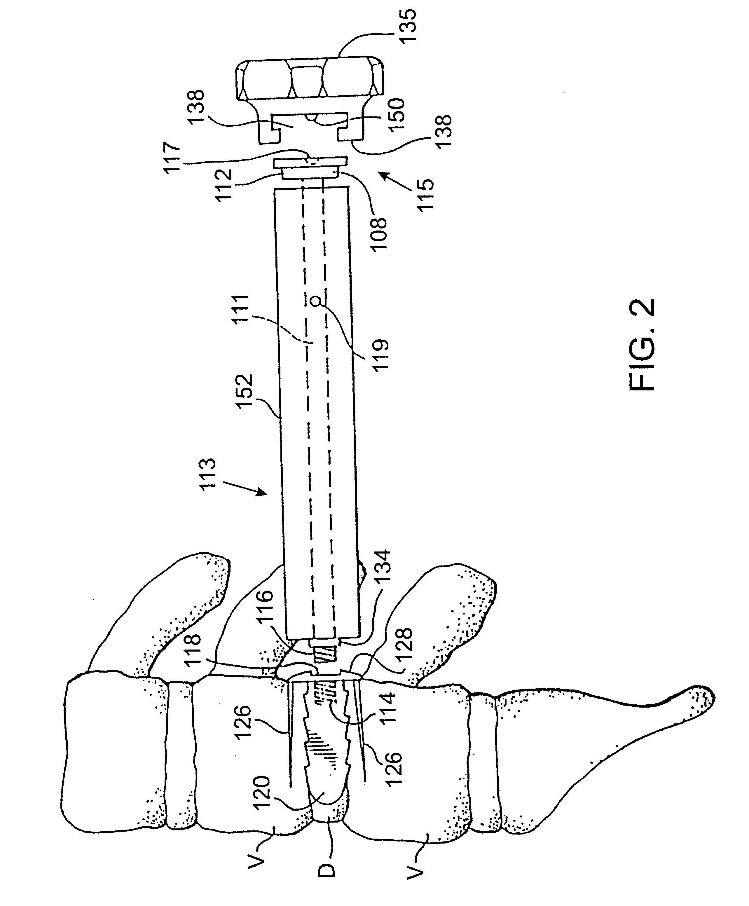 Apparatus for inserting spinal implants