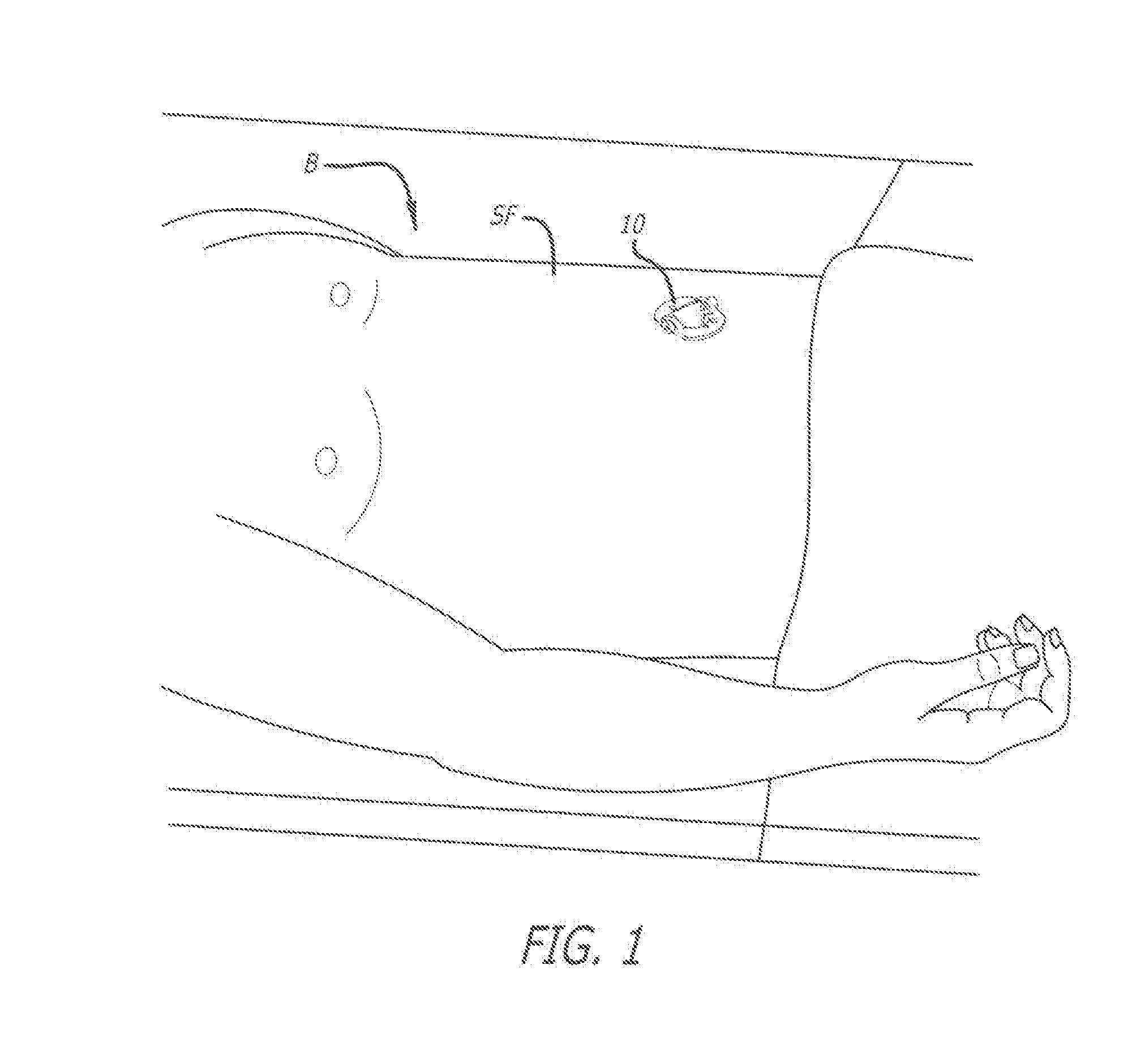 Surgical cannula with channels for irrigation and suction