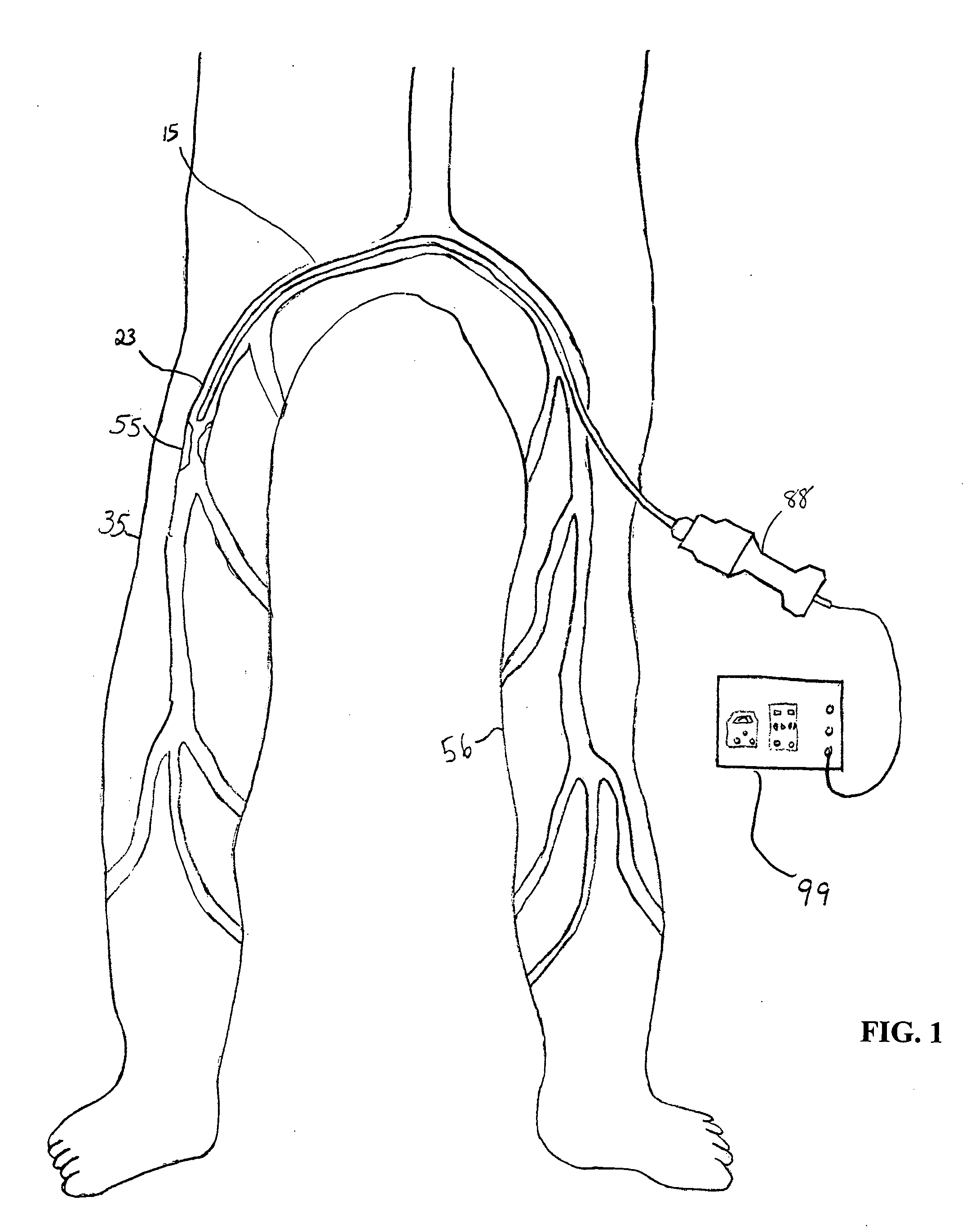 Apparatus and method for an ultrasonic medical device to treat peripheral artery disease