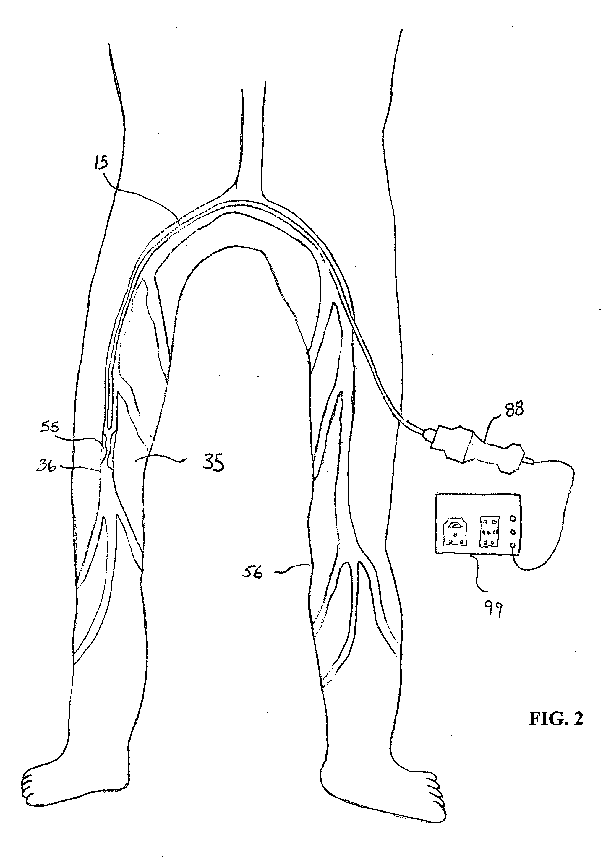 Apparatus and method for an ultrasonic medical device to treat peripheral artery disease
