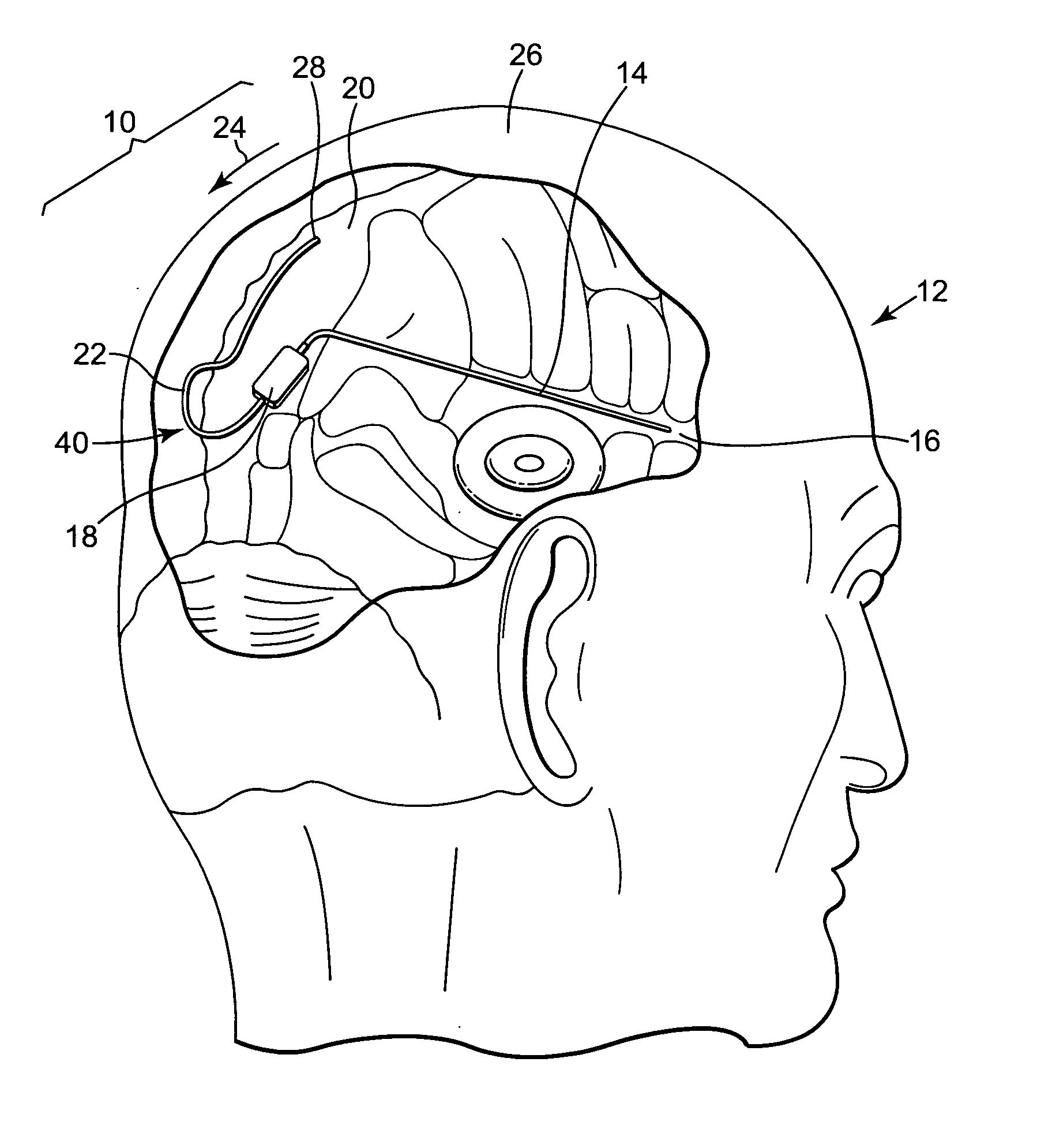 Apparatus and method for retrograde placement of sagittal sinus drainage catheter