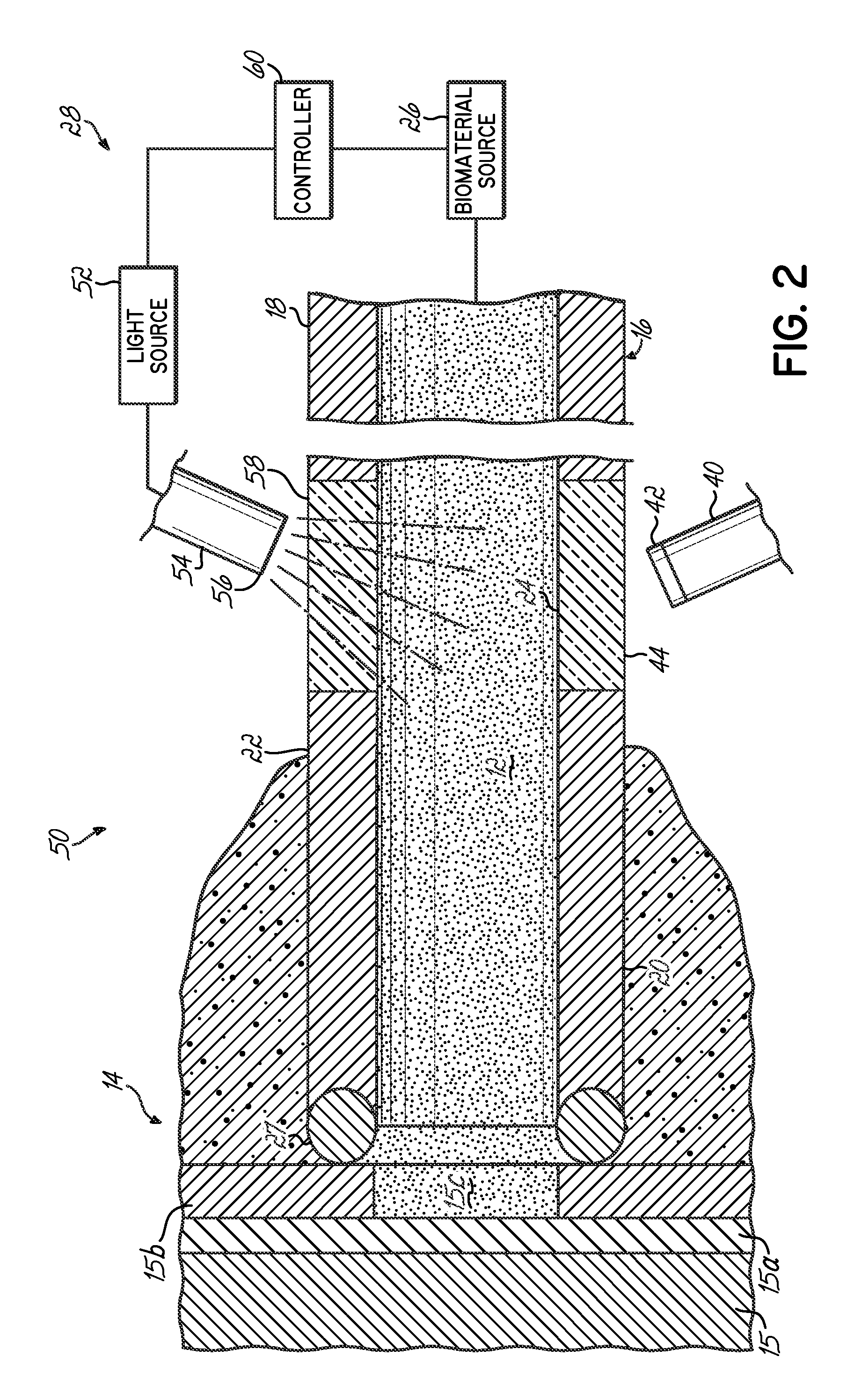 Apparatus and method for delivering a biocompatible material to a surgical site