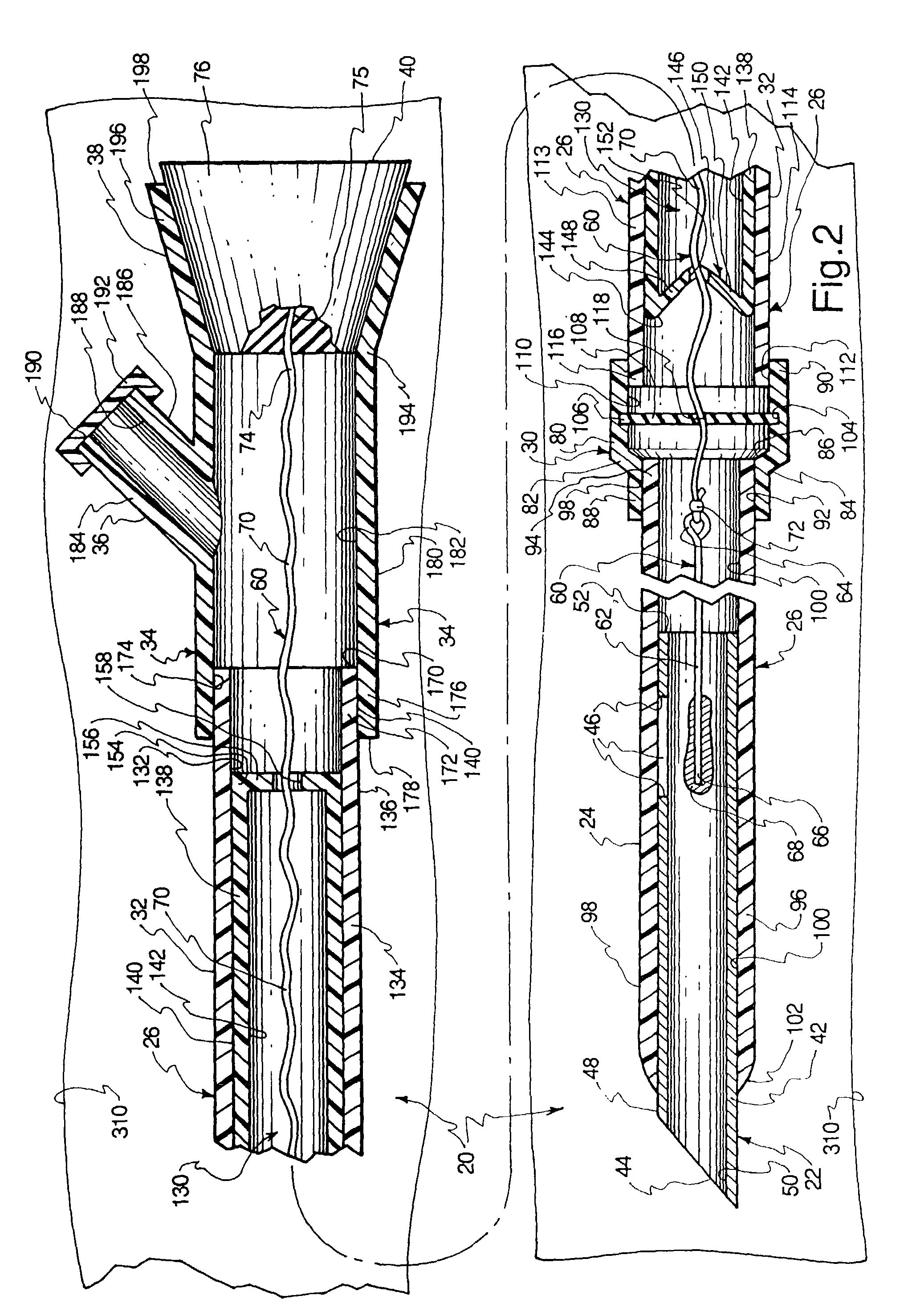 Trapping of intravenous needle associated with a long catheter, and related methods