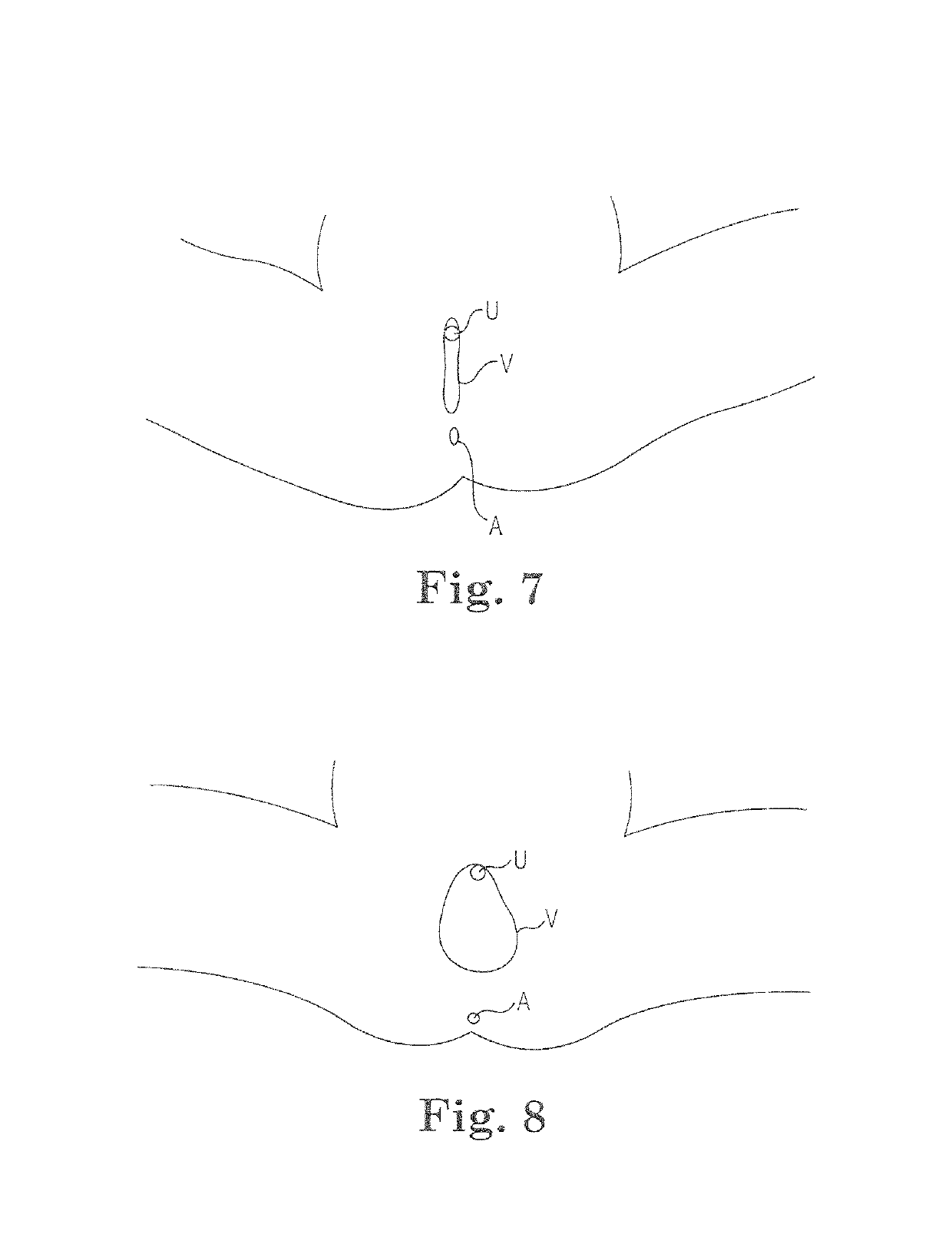 Elongate implant system and method for treating pelvic conditions