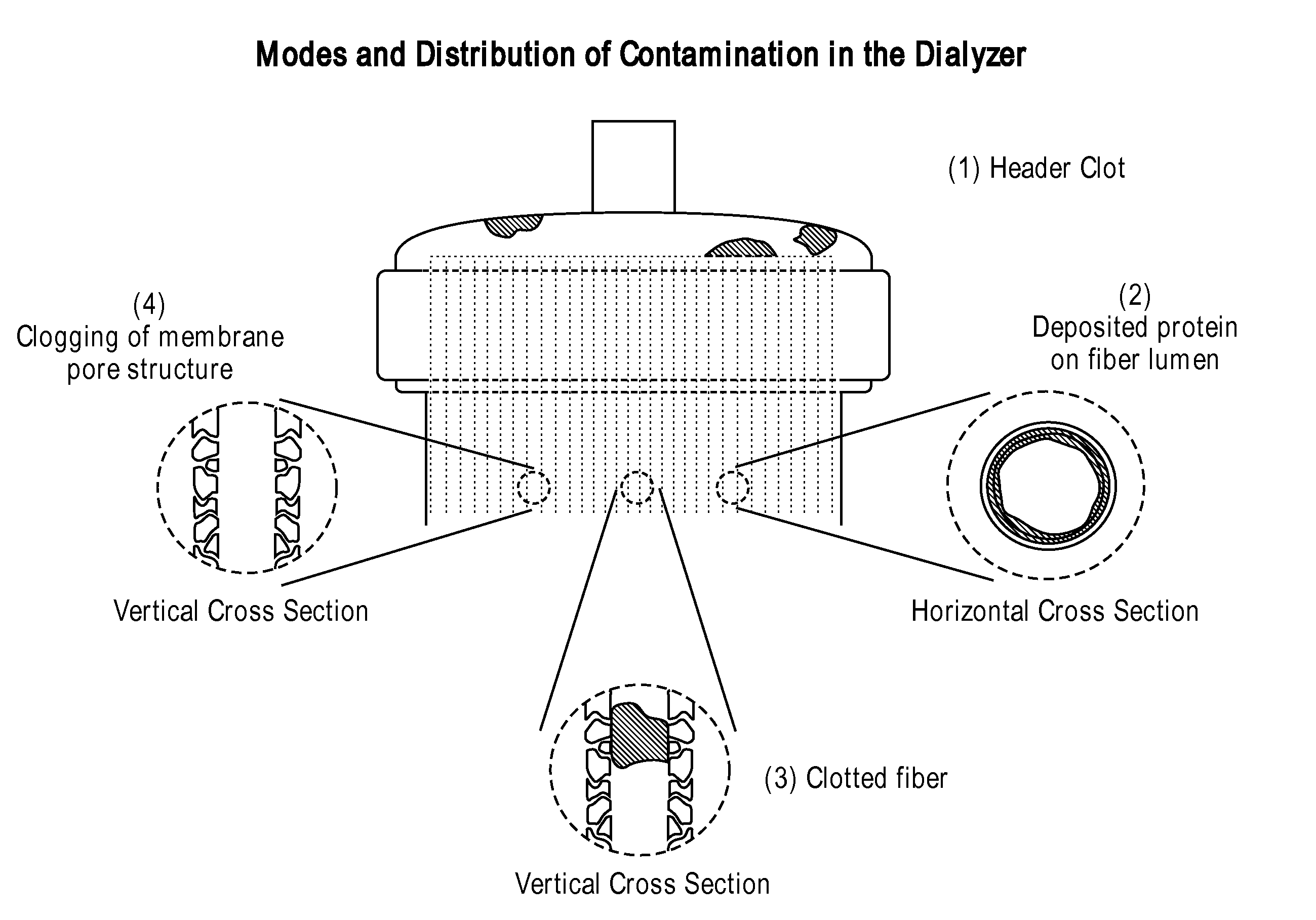 Compositions and methods of cleaning polyvinyl pyrrolidone-based hemodialysis filtration membrane assemblies