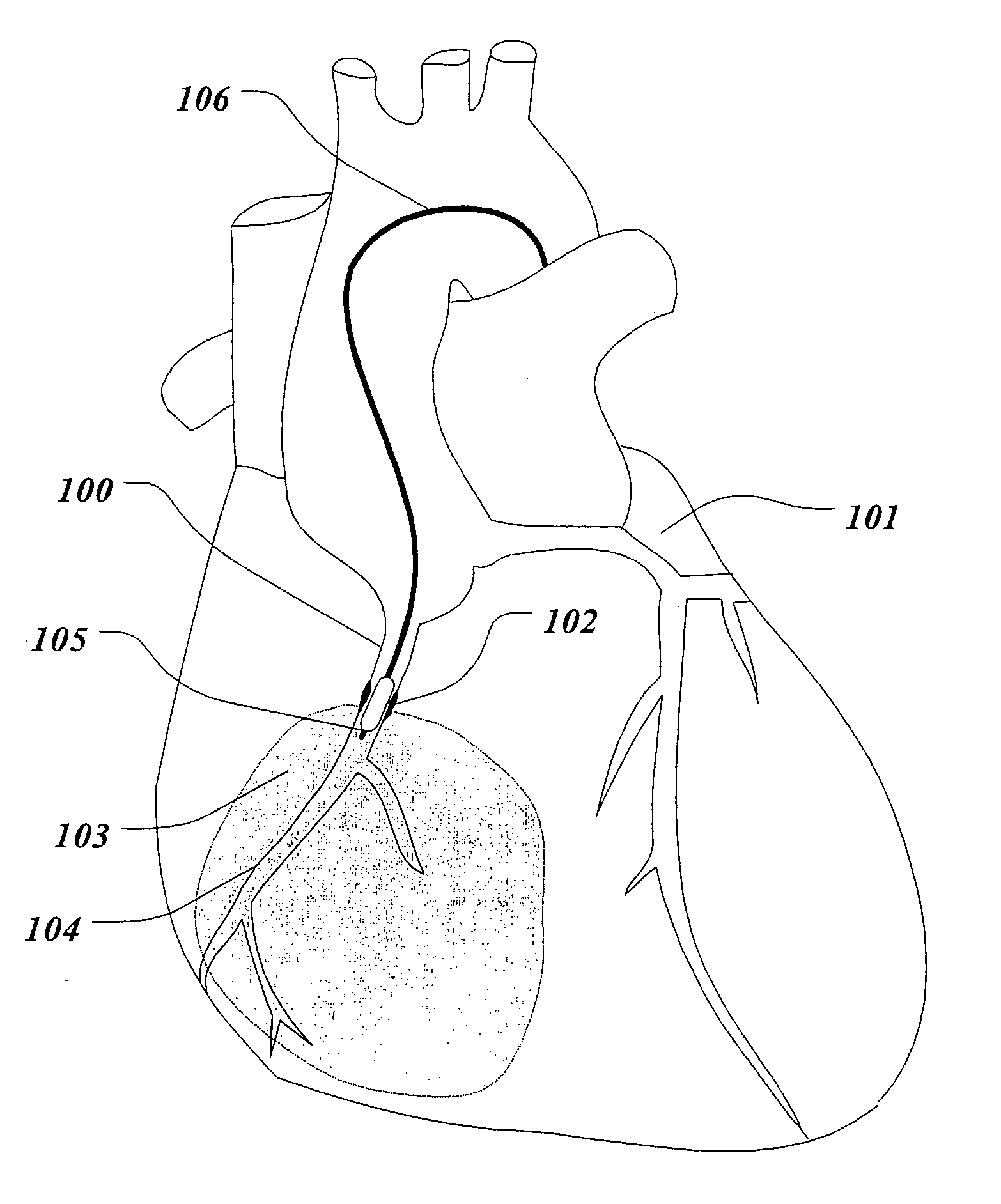 System and method for the treatment of reperfusion injury