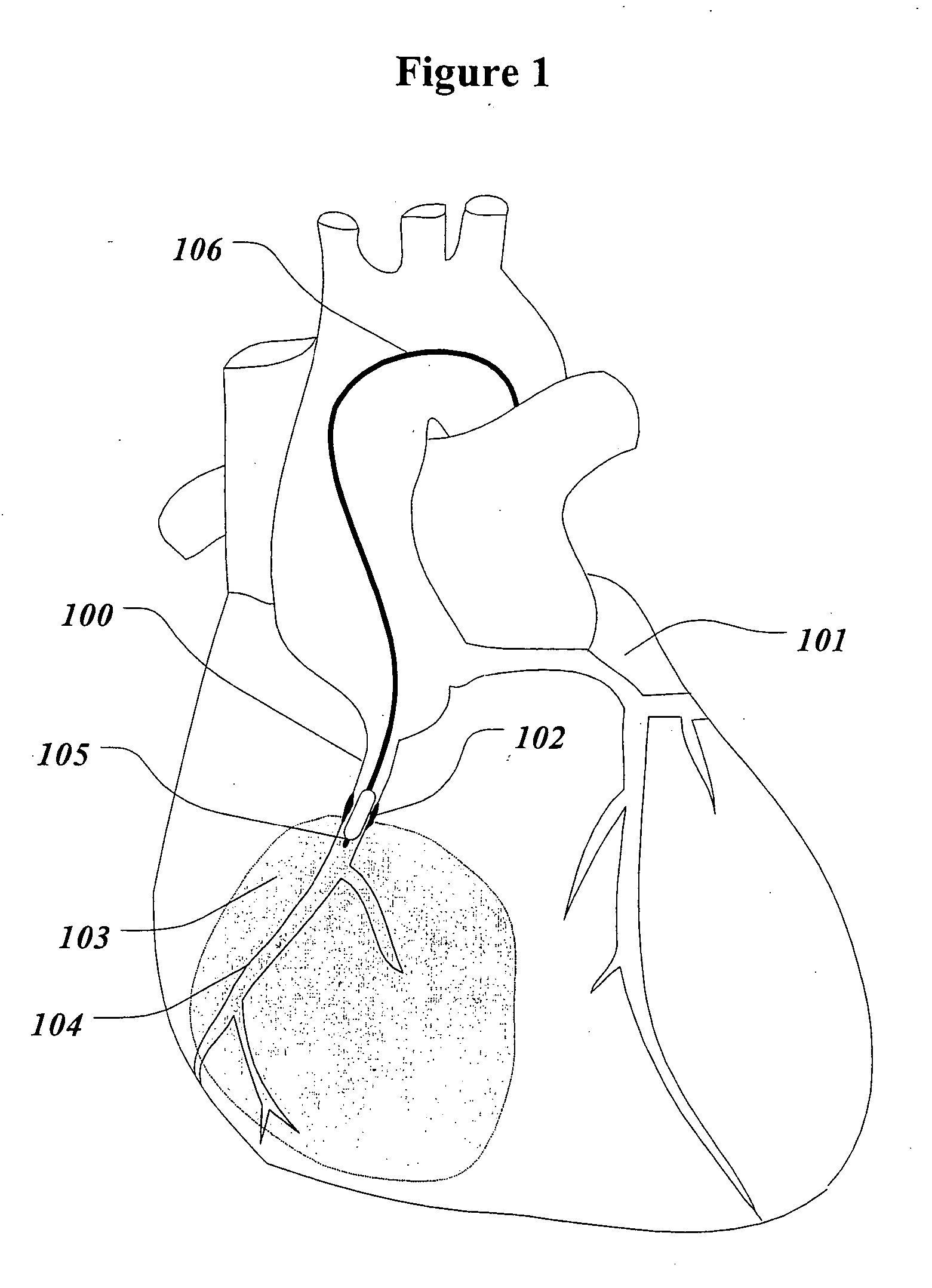 System and method for the treatment of reperfusion injury