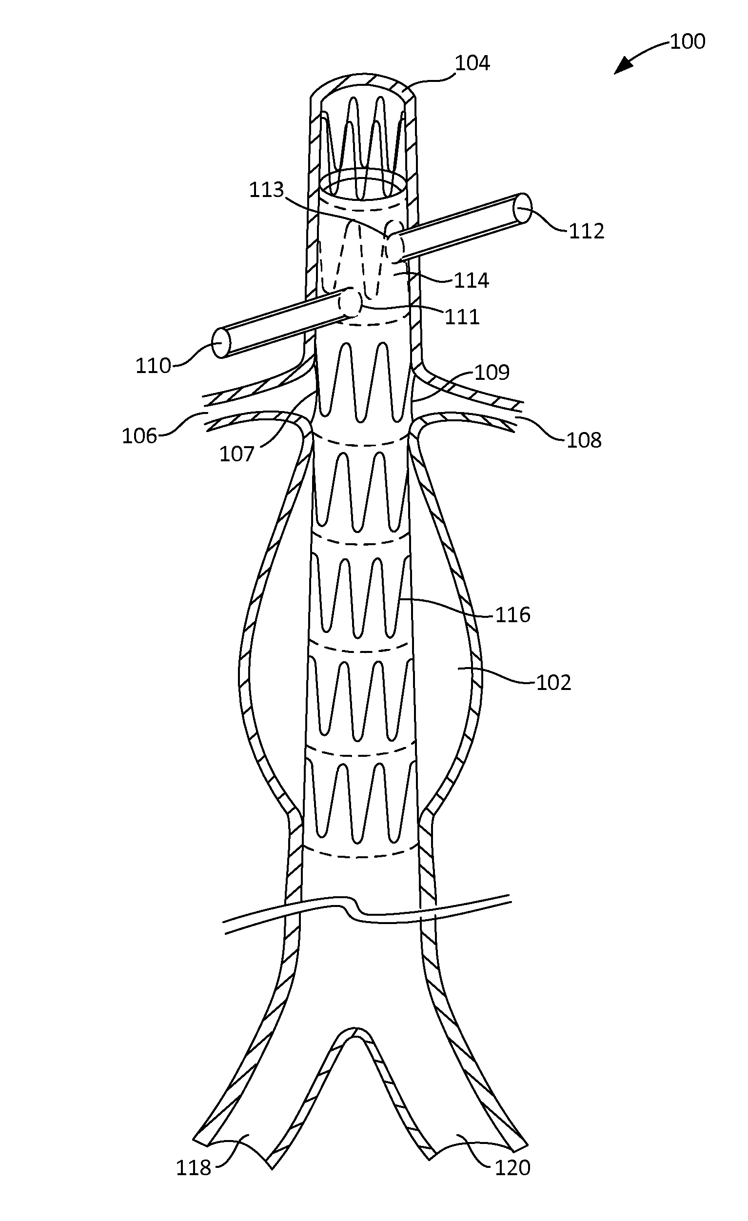 Fenestration template for endovascular repair of aortic aneurysms
