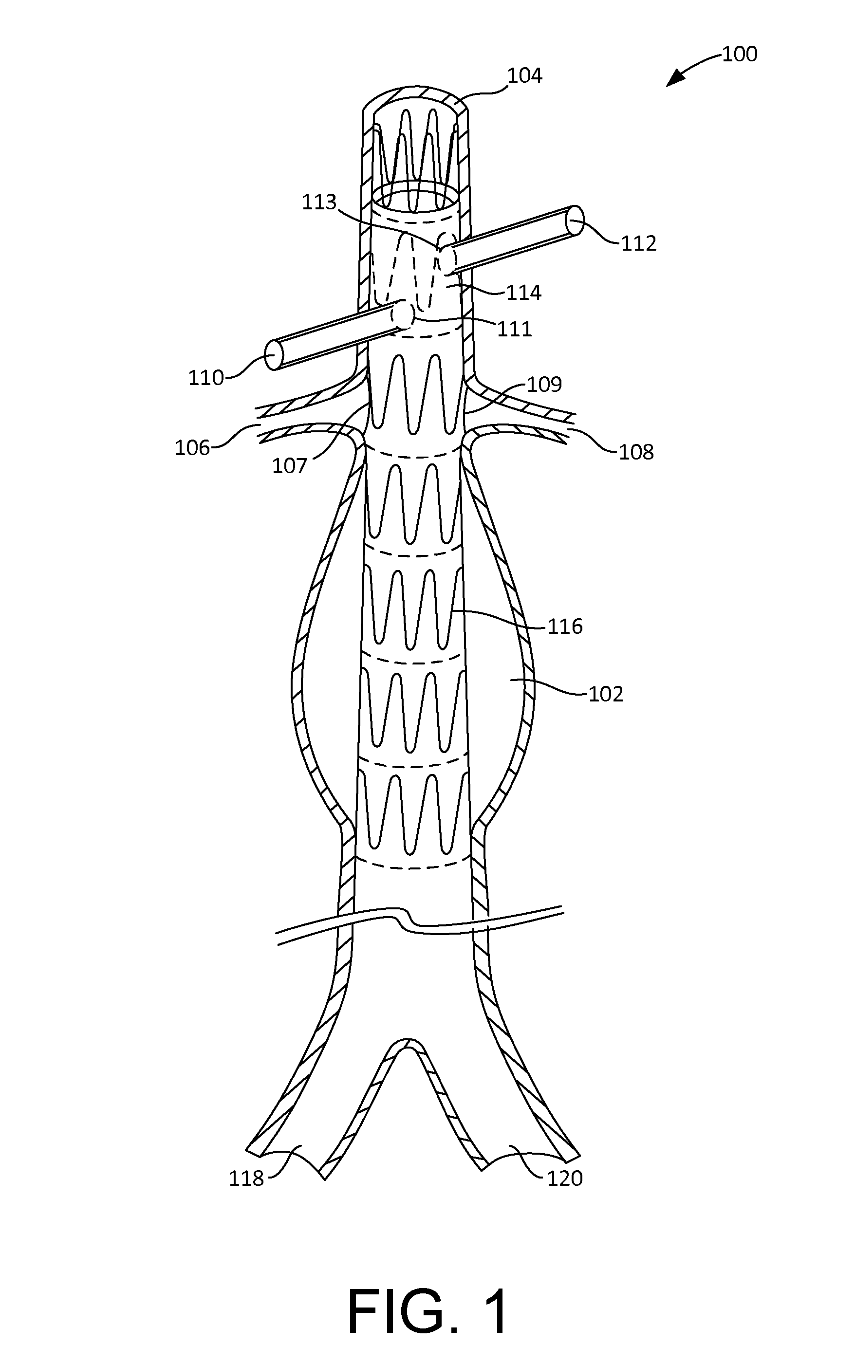 Fenestration template for endovascular repair of aortic aneurysms