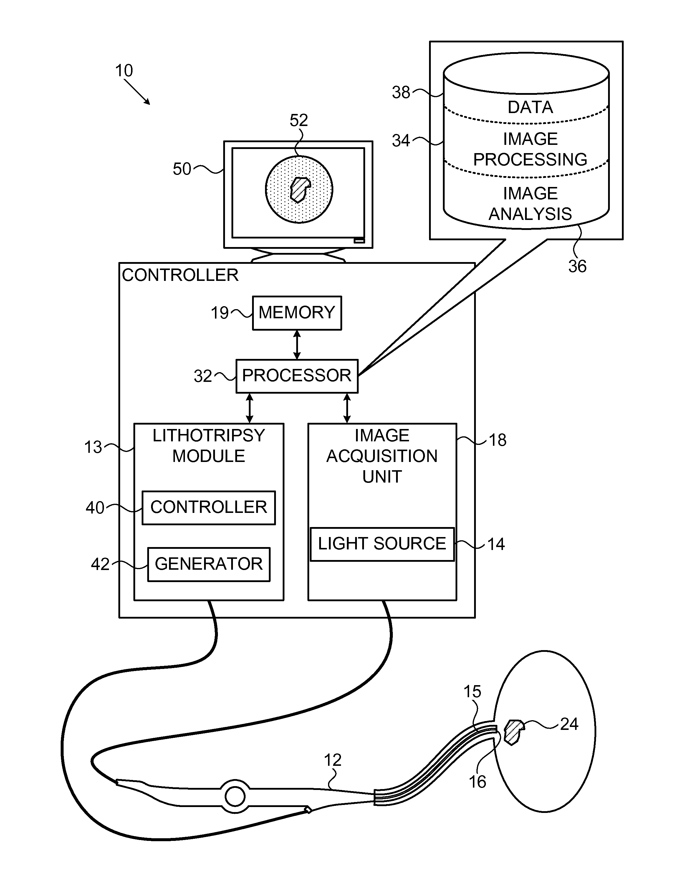 Computer aided image-based enhanced intracorporeal lithotripsy