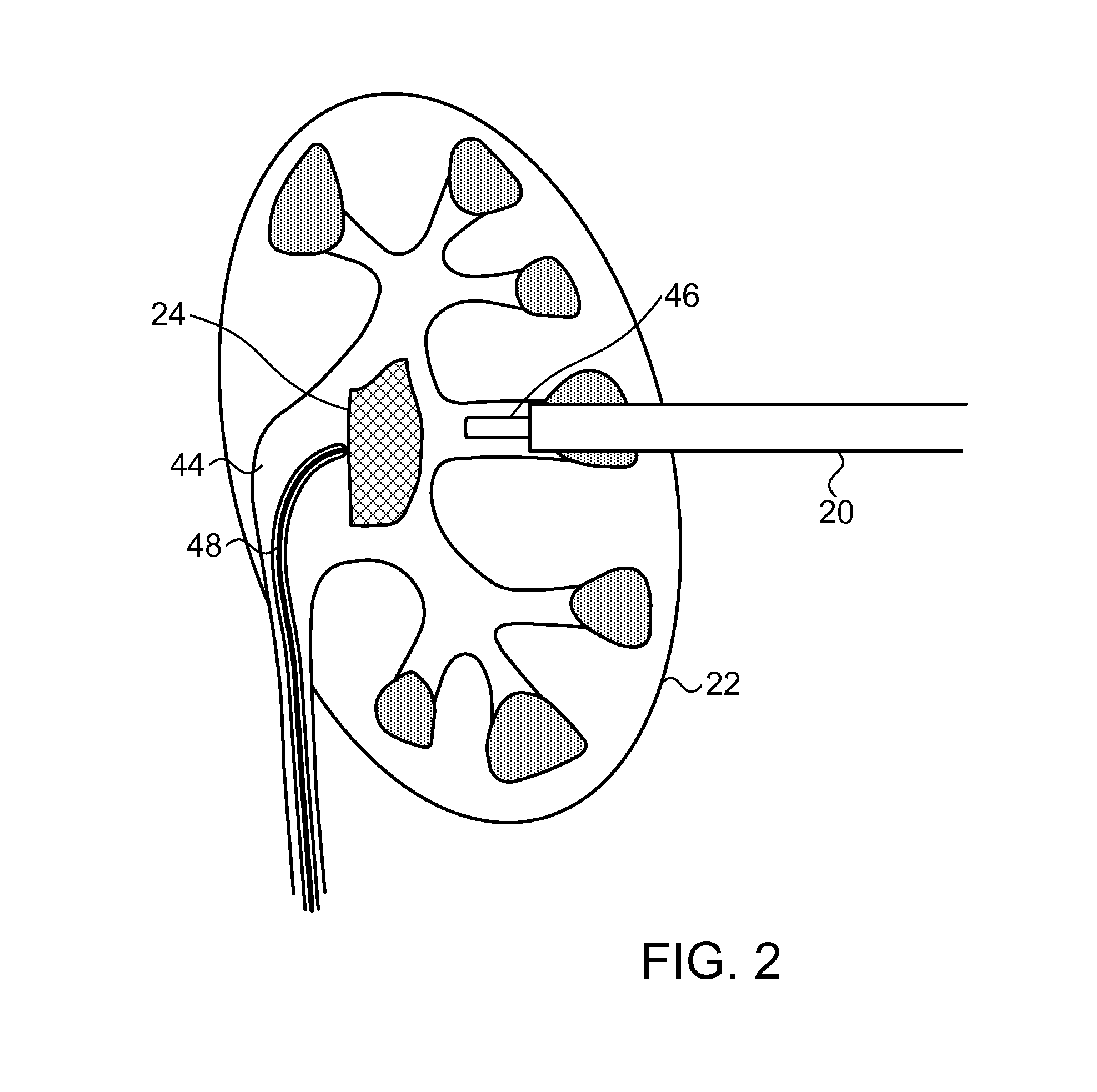 Computer aided image-based enhanced intracorporeal lithotripsy