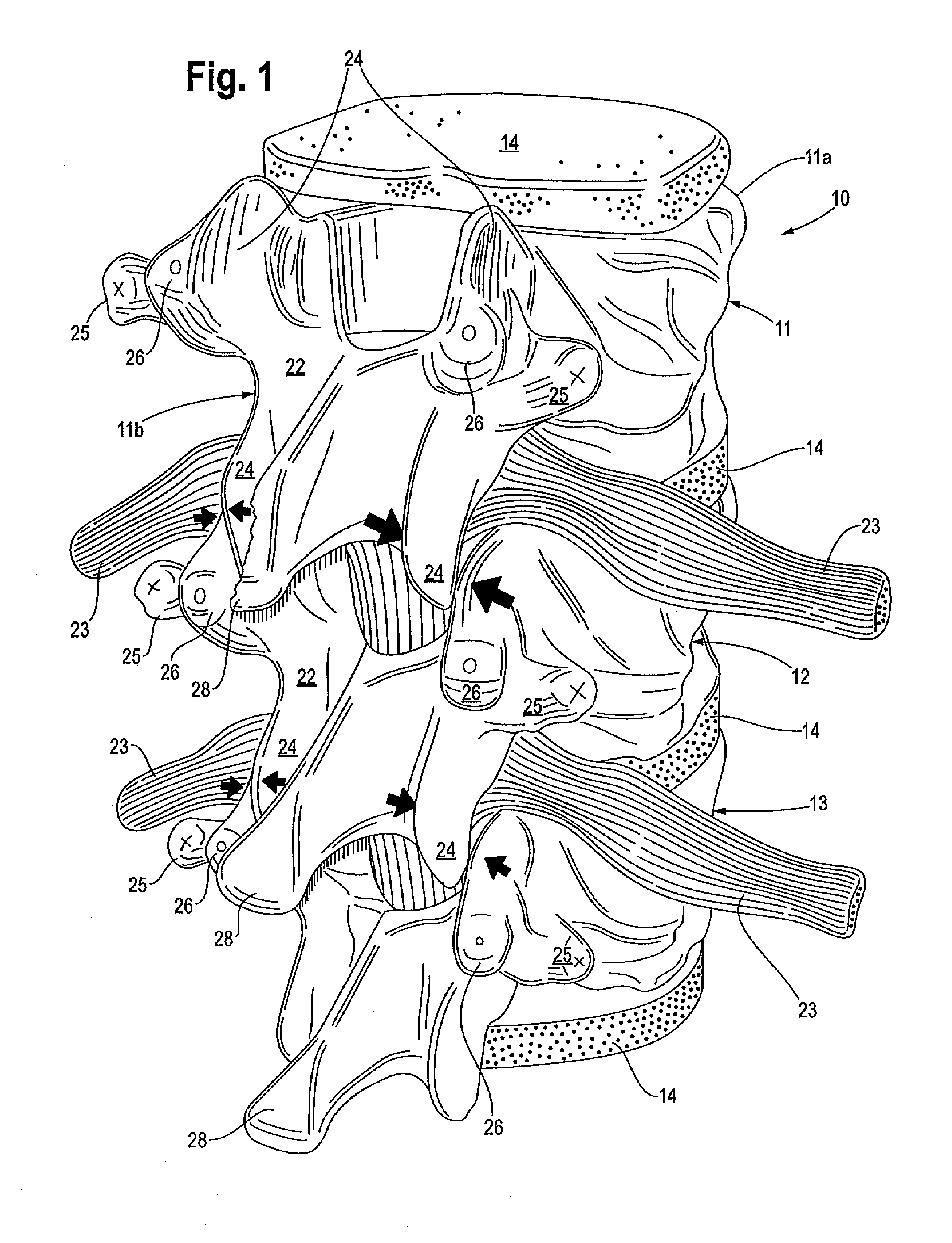 Method for placing spinal implants