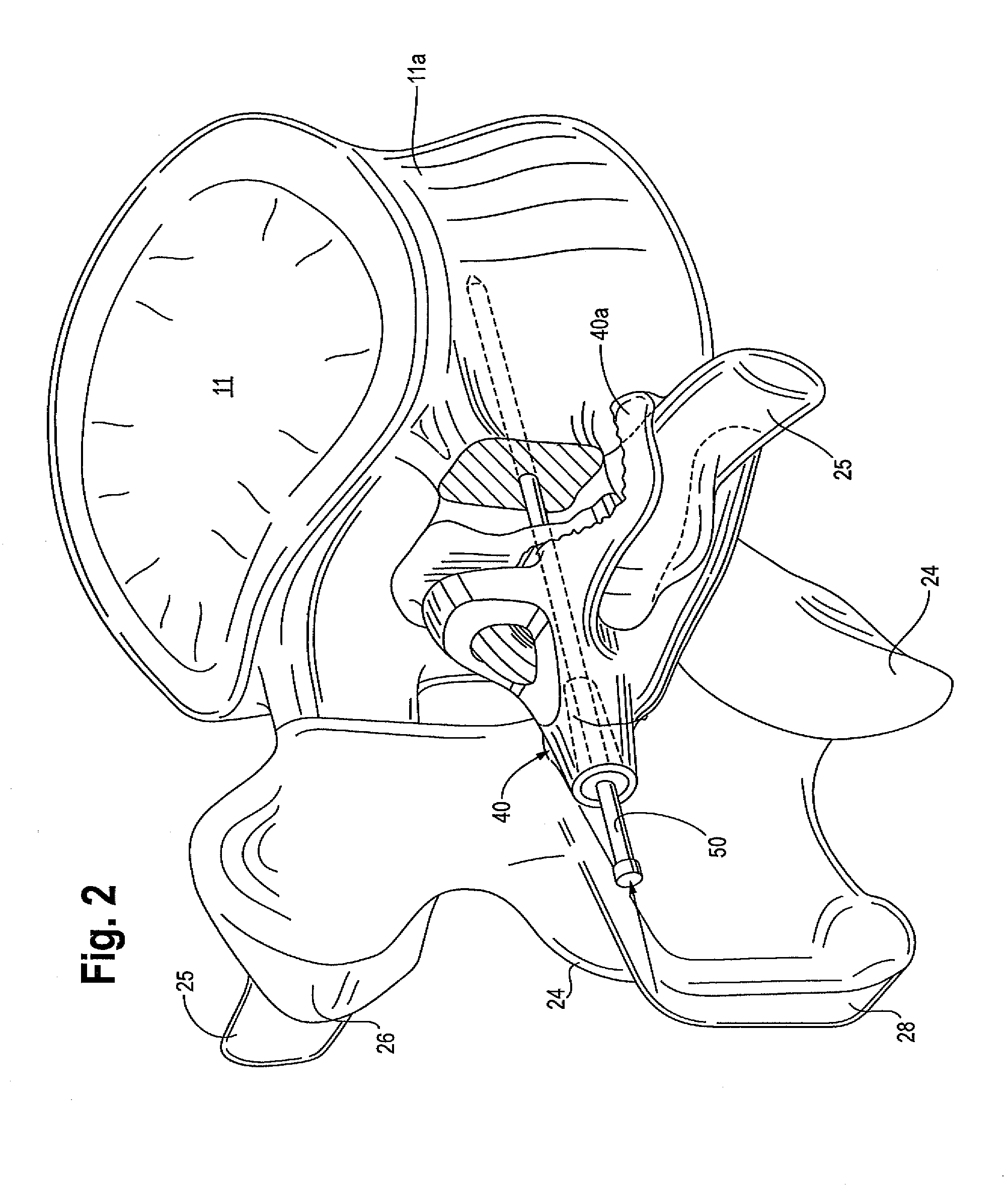 Method for placing spinal implants