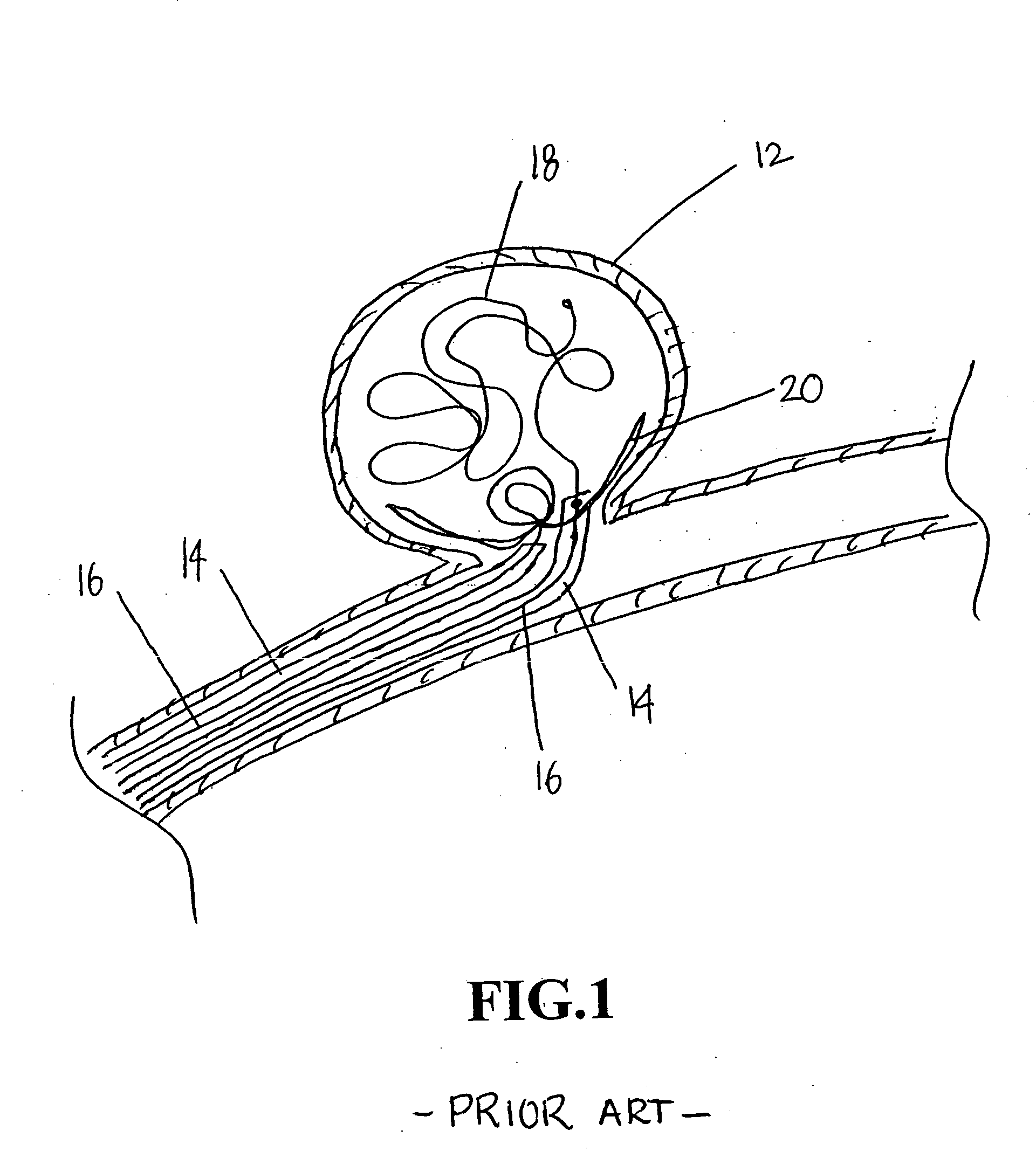 Methods and devices for endothelial denudation to prevent recanalization after embolization