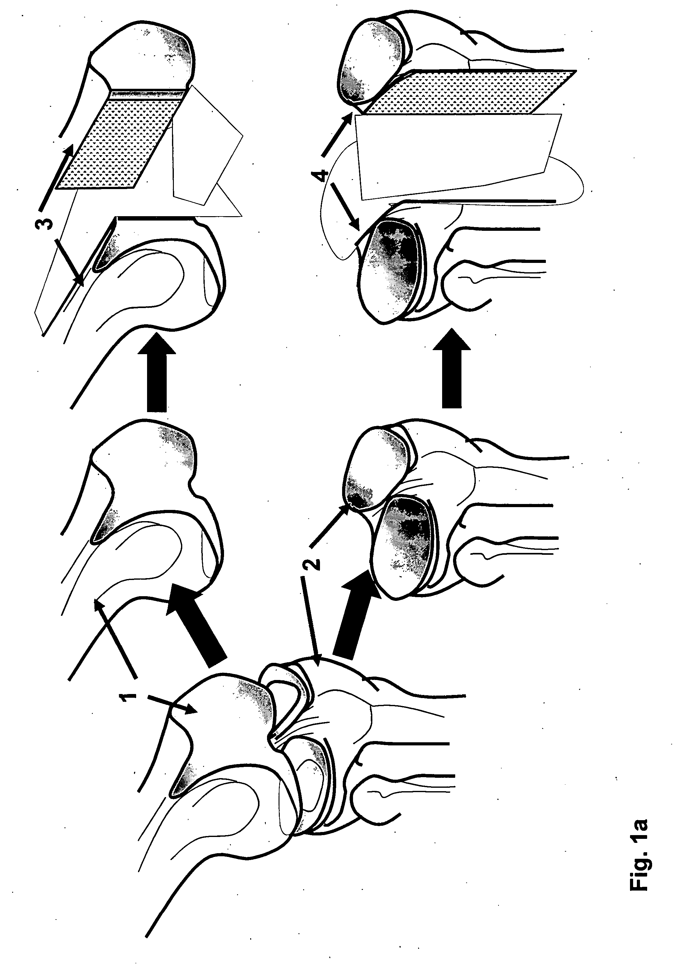 Implantation of Cartilage