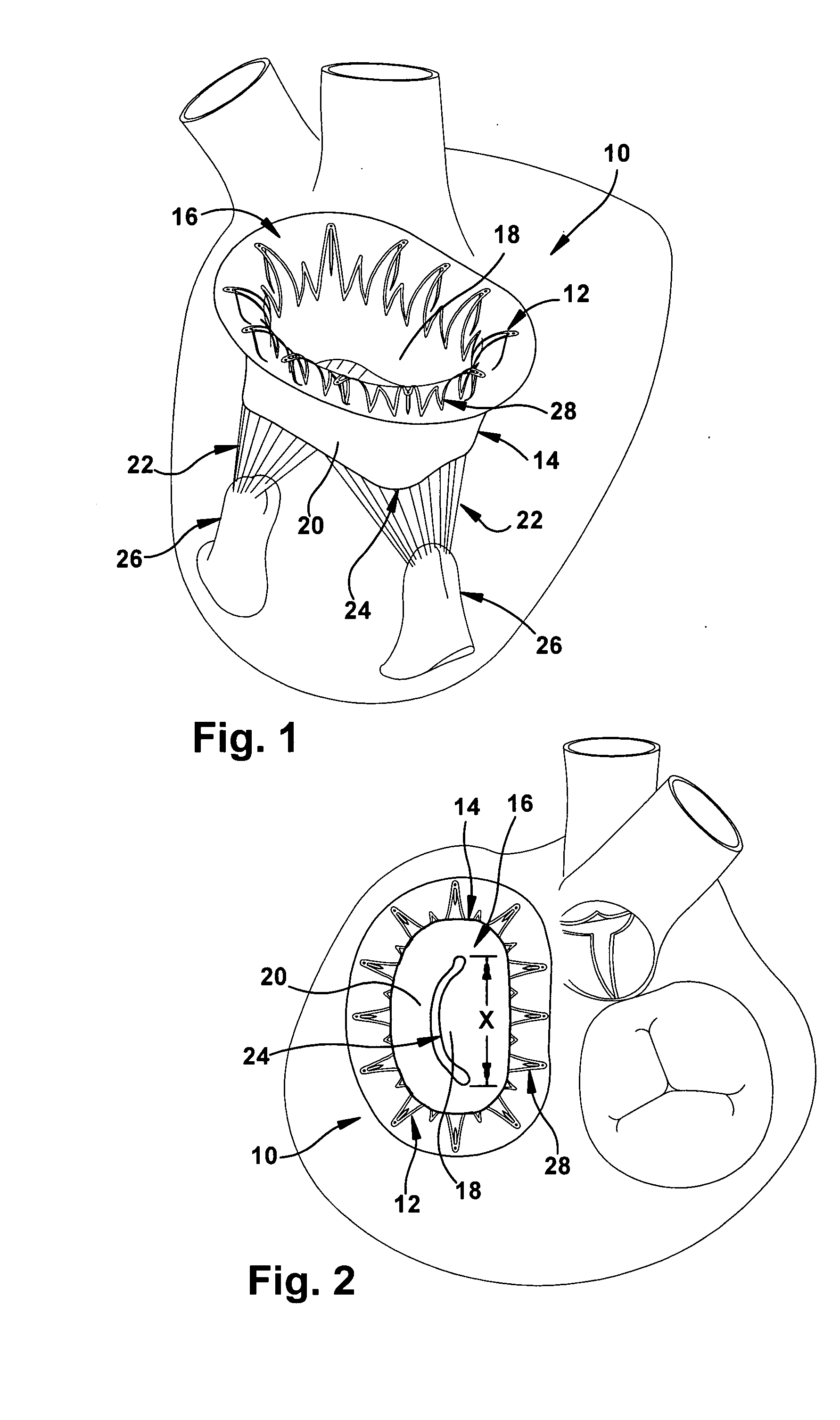 Apparatus and methods for repair of a cardiac valve