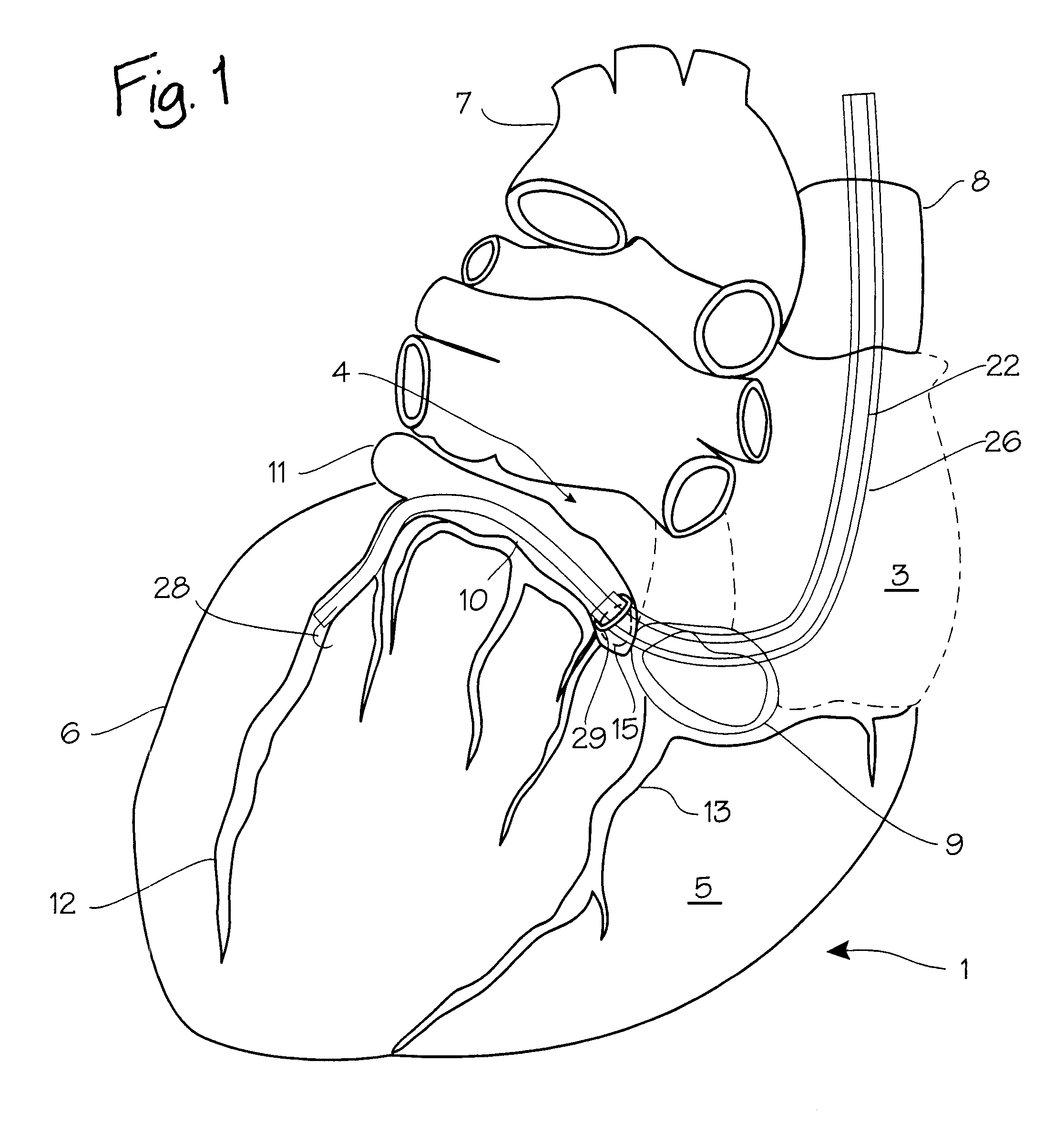 Method of treating the heart