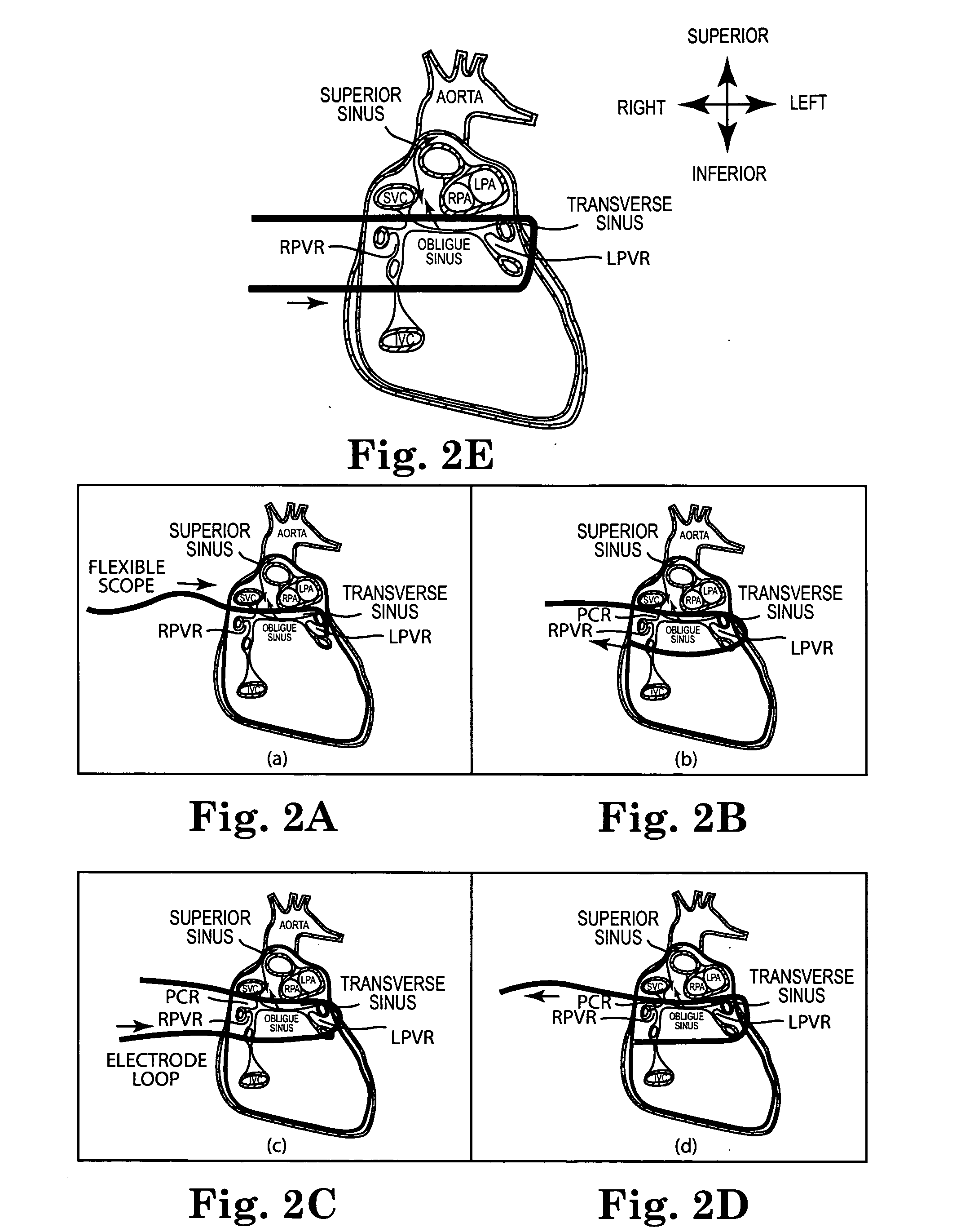 Loop ablation apparatus and method