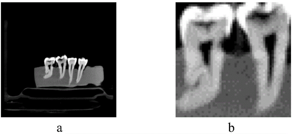 Dental caries image processing method based on extracted tooth CBCT