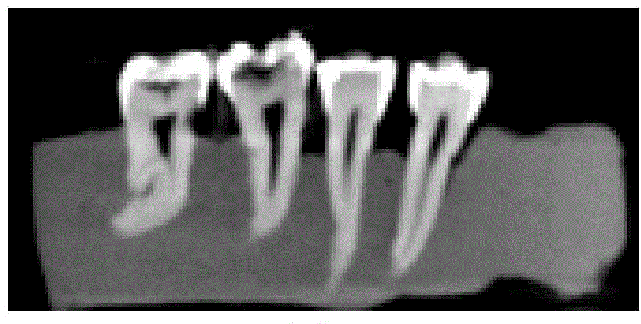 Dental caries image processing method based on extracted tooth CBCT