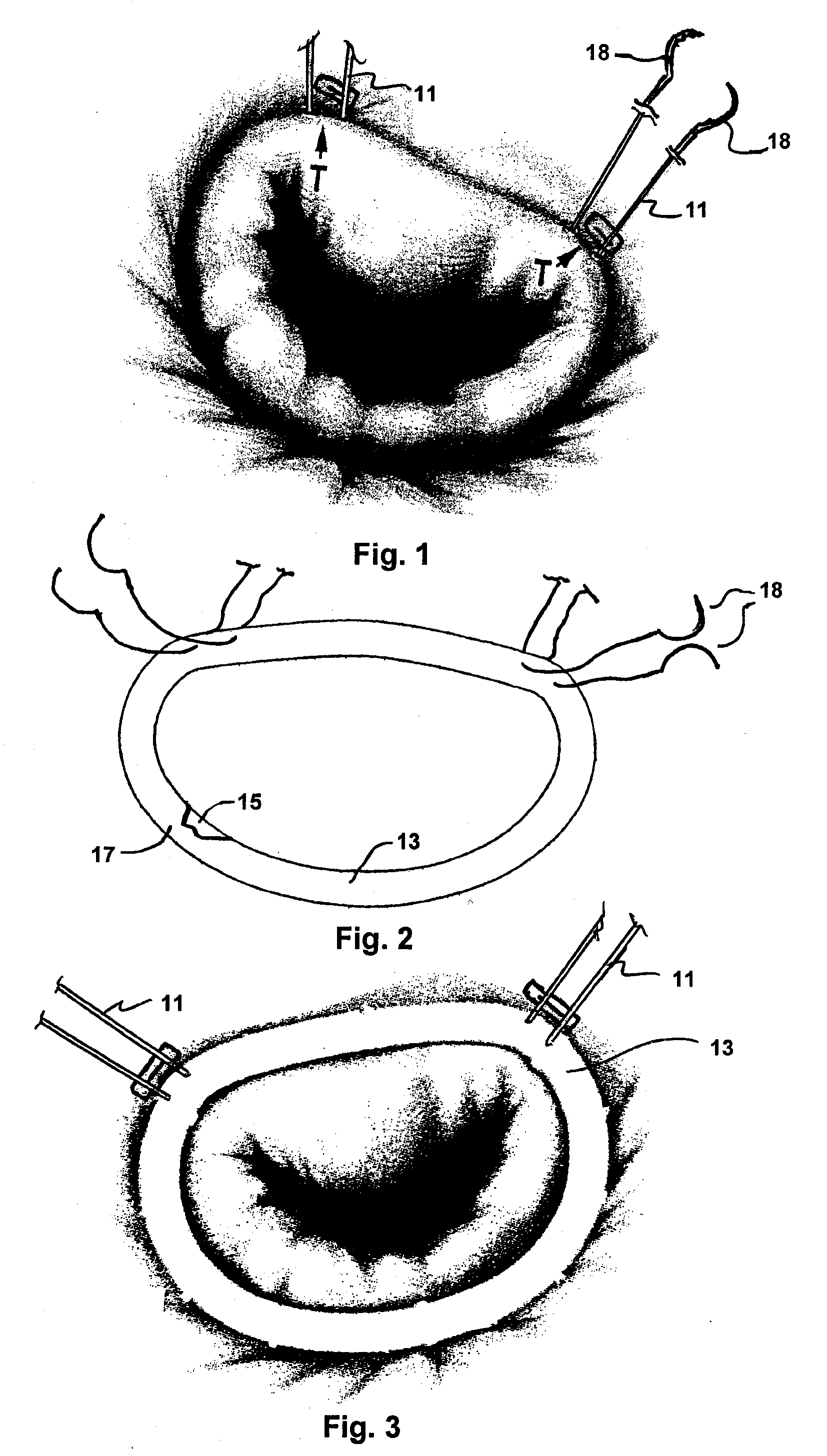Implantation system for annuloplasty rings