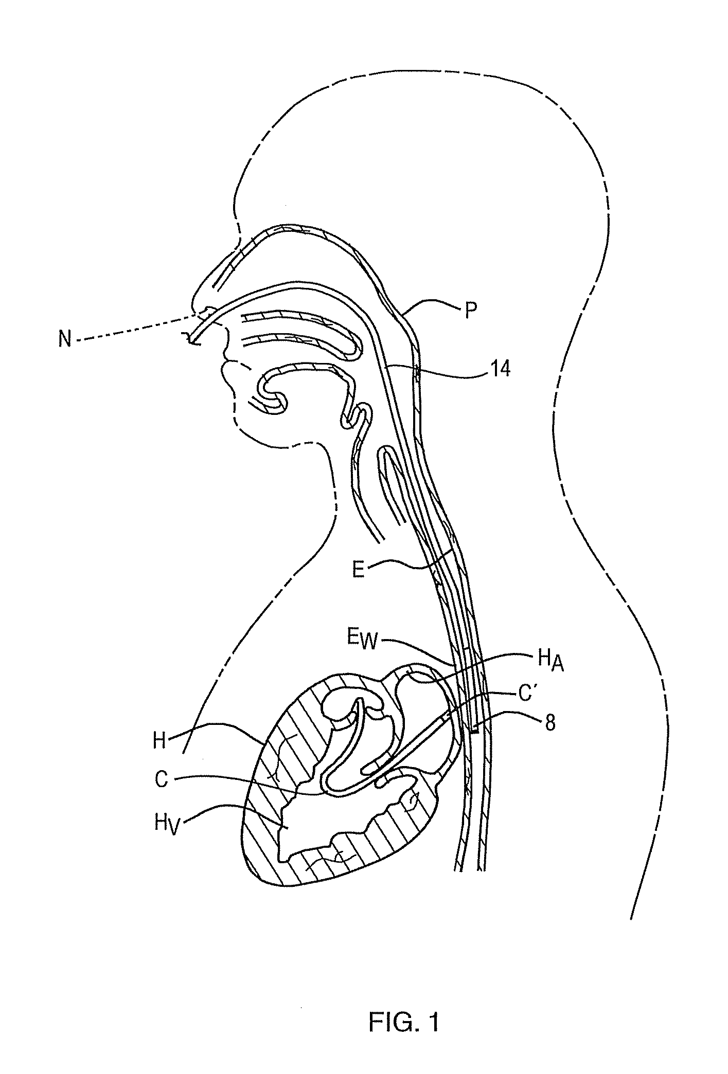 Method and apparatus for minimizing thermal trauma to an organ during tissue ablation of a different organ