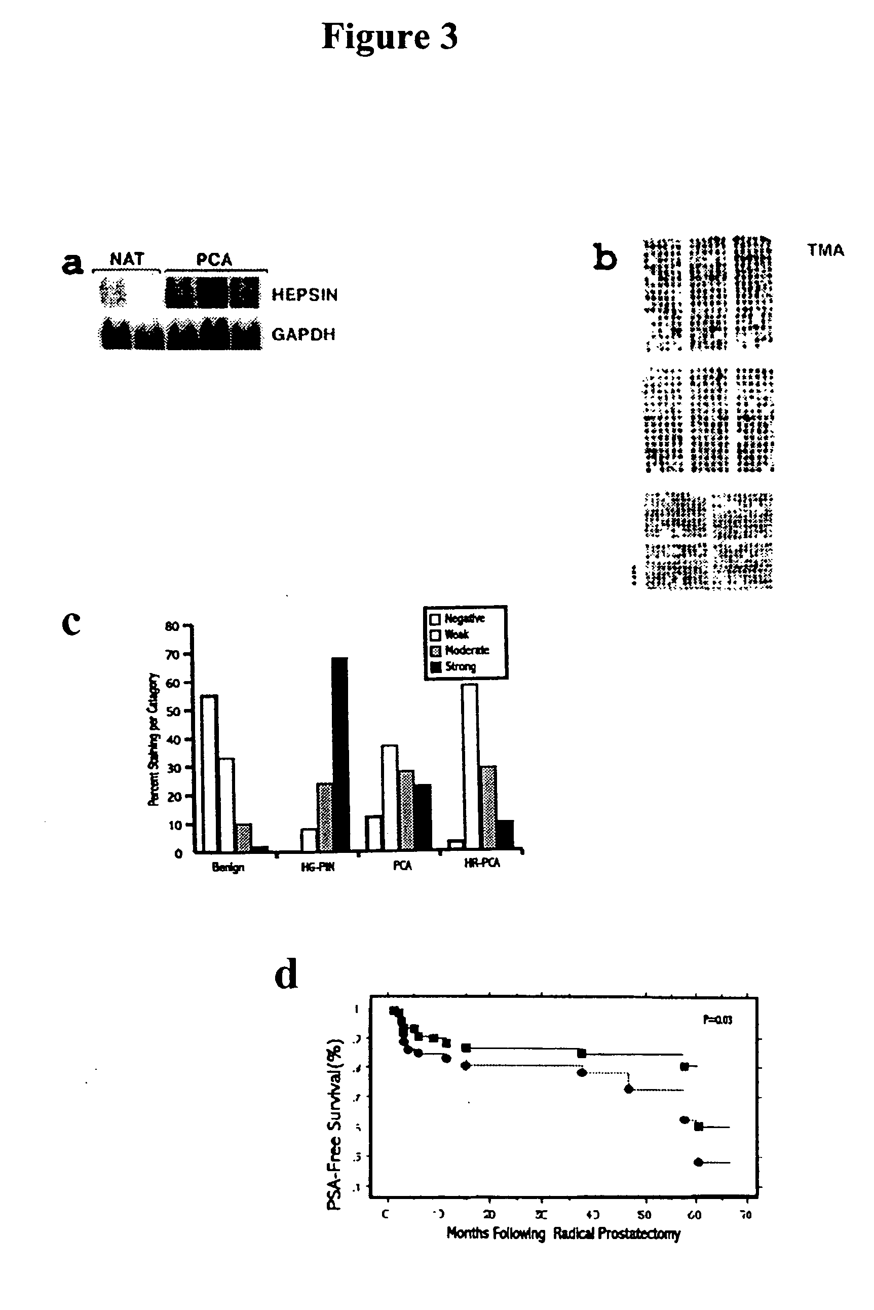 Expression profile of prostate cancer