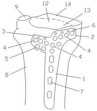 A tibial plateau three-column anatomical bone plate
