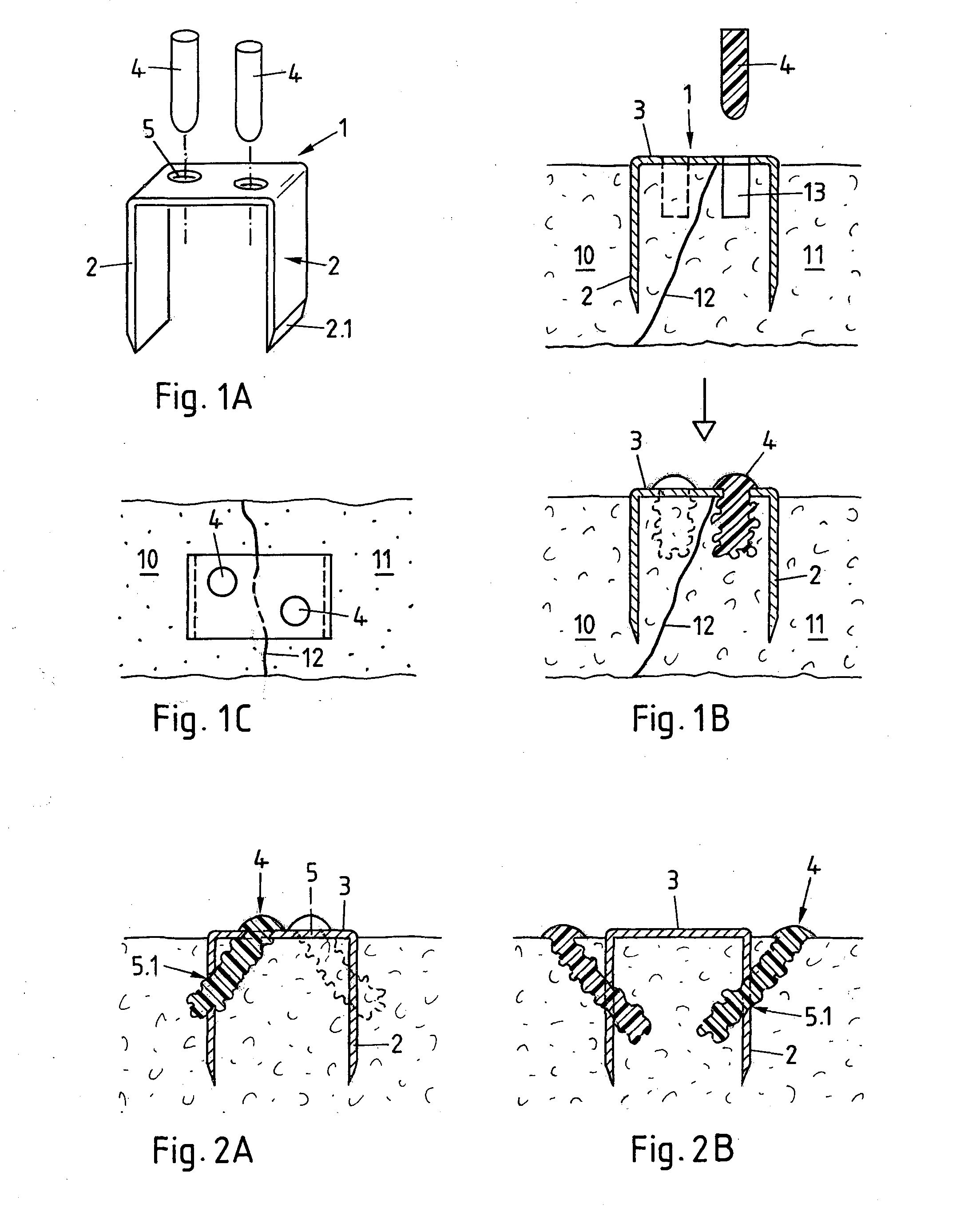 Method and implant for stabilizing separated bone portions relative to each other