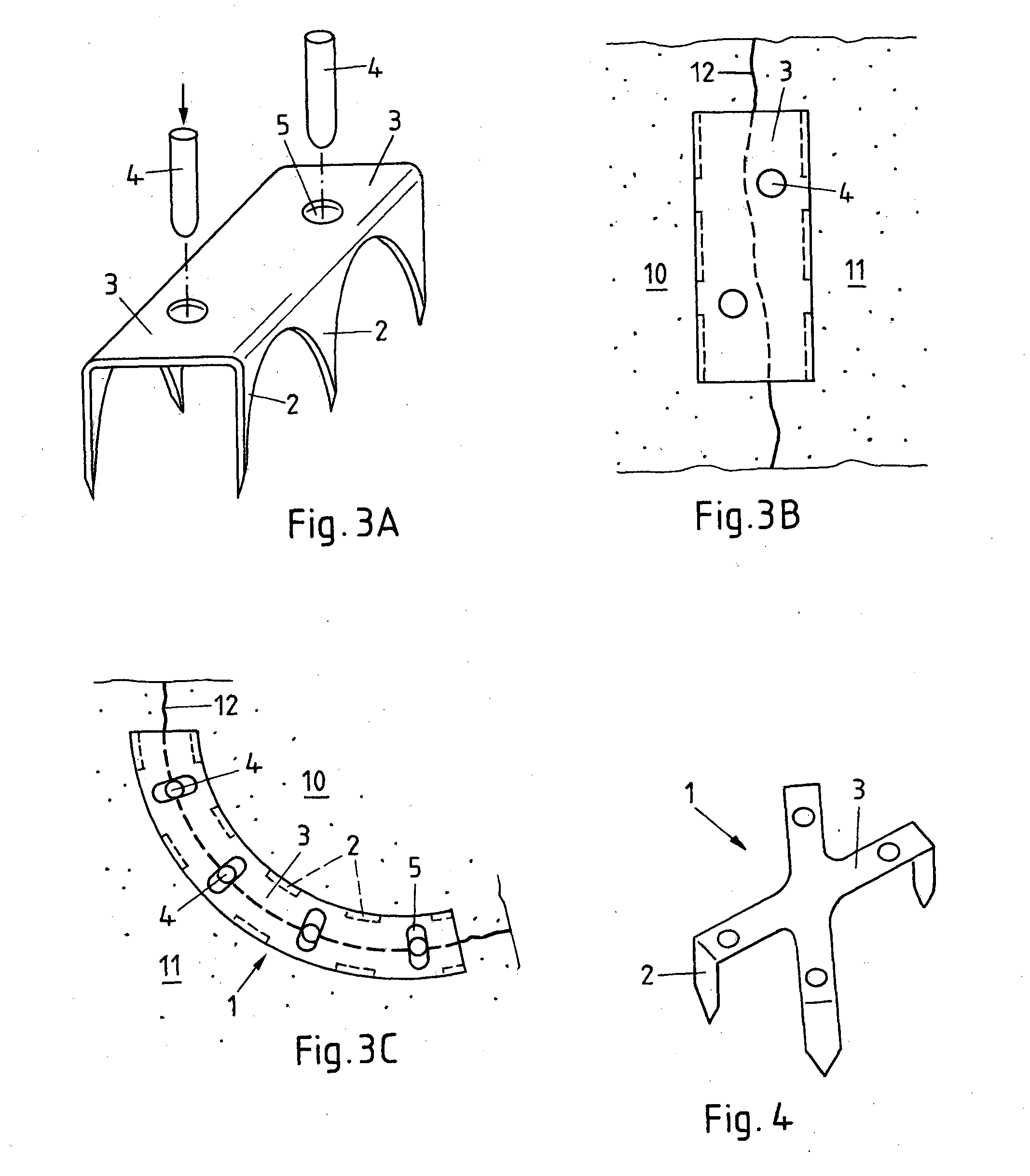 Method and implant for stabilizing separated bone portions relative to each other