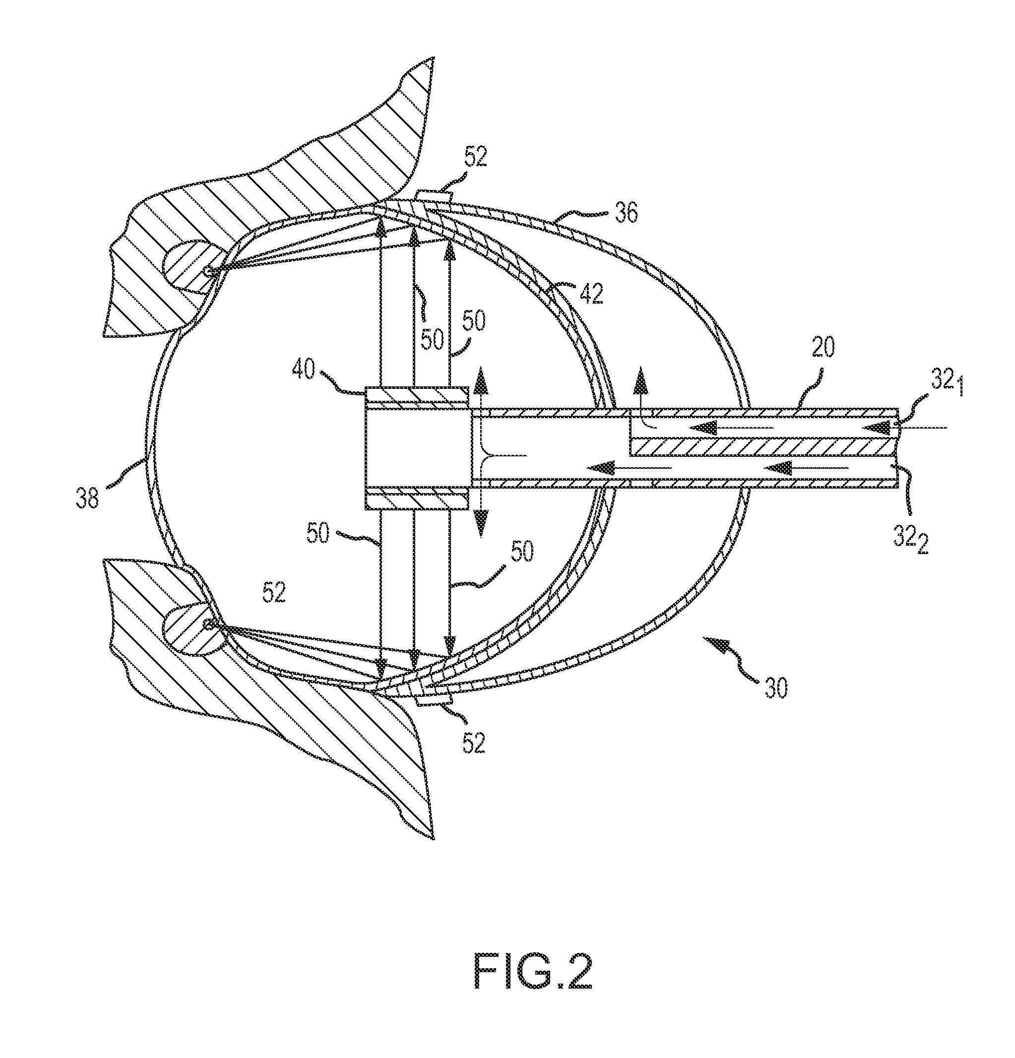 Ablation system with blood leakage minimization and tissue protective capabilities