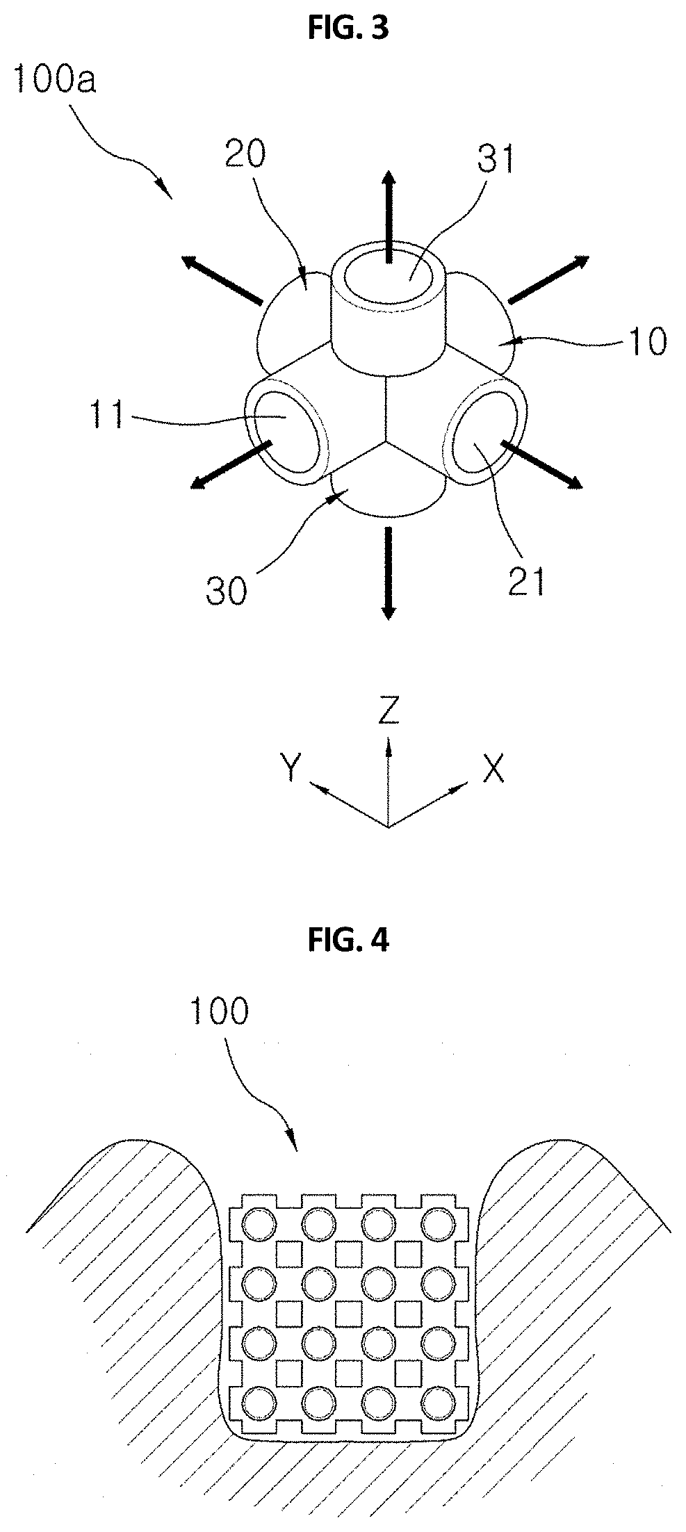 3-dimensional block type bone graft