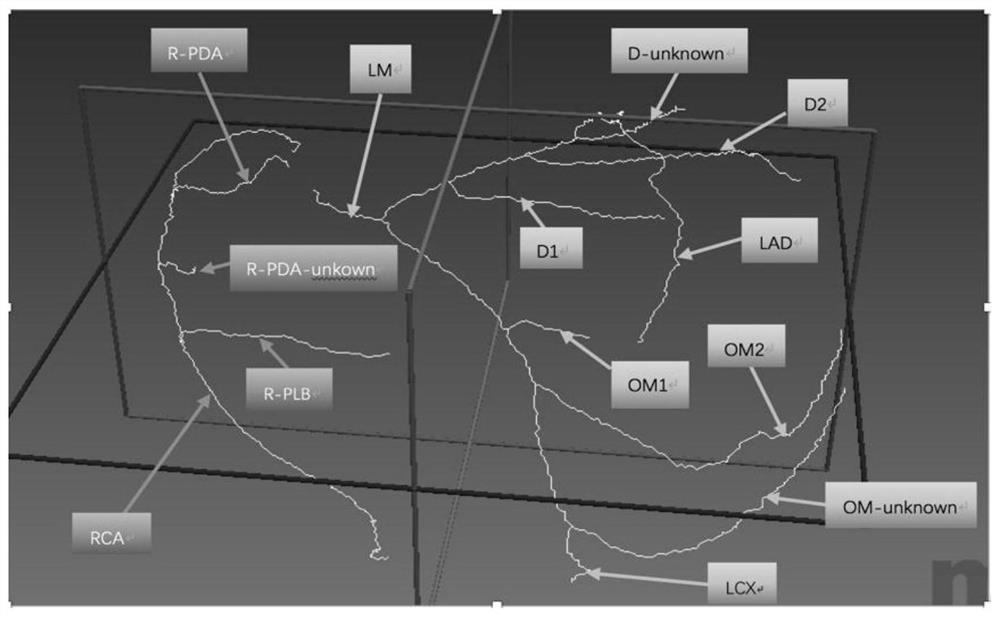 Automatic Segmentation Naming Method for Cardiac Coronary Vessels