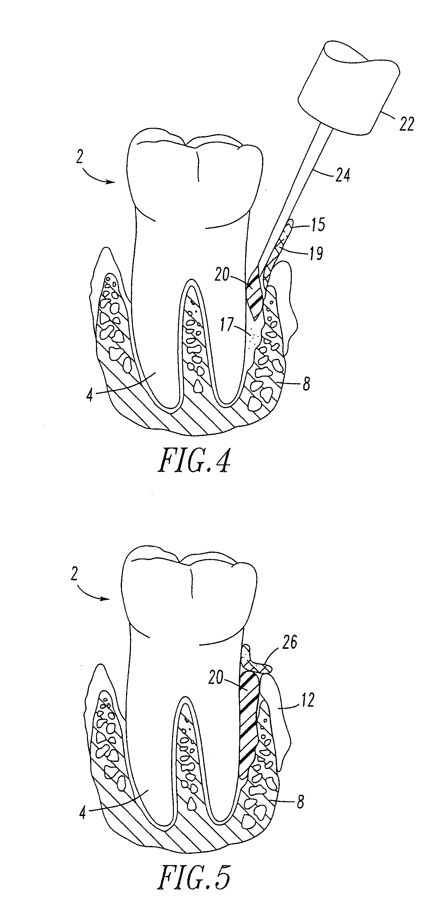 Periodontal regeneration composition and method of using same