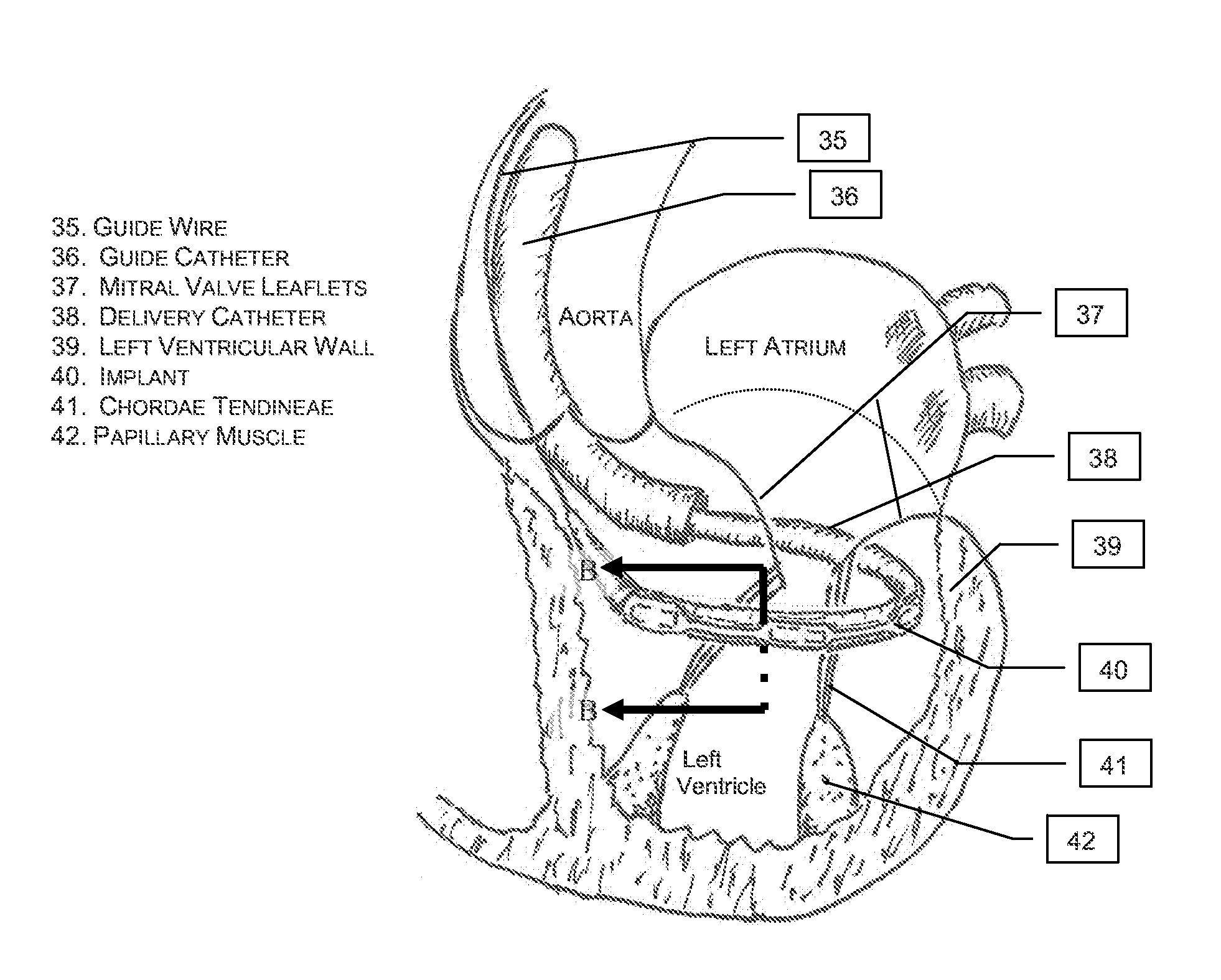 Implantable Tissue Structure Modifiers and Methods for Using the Same